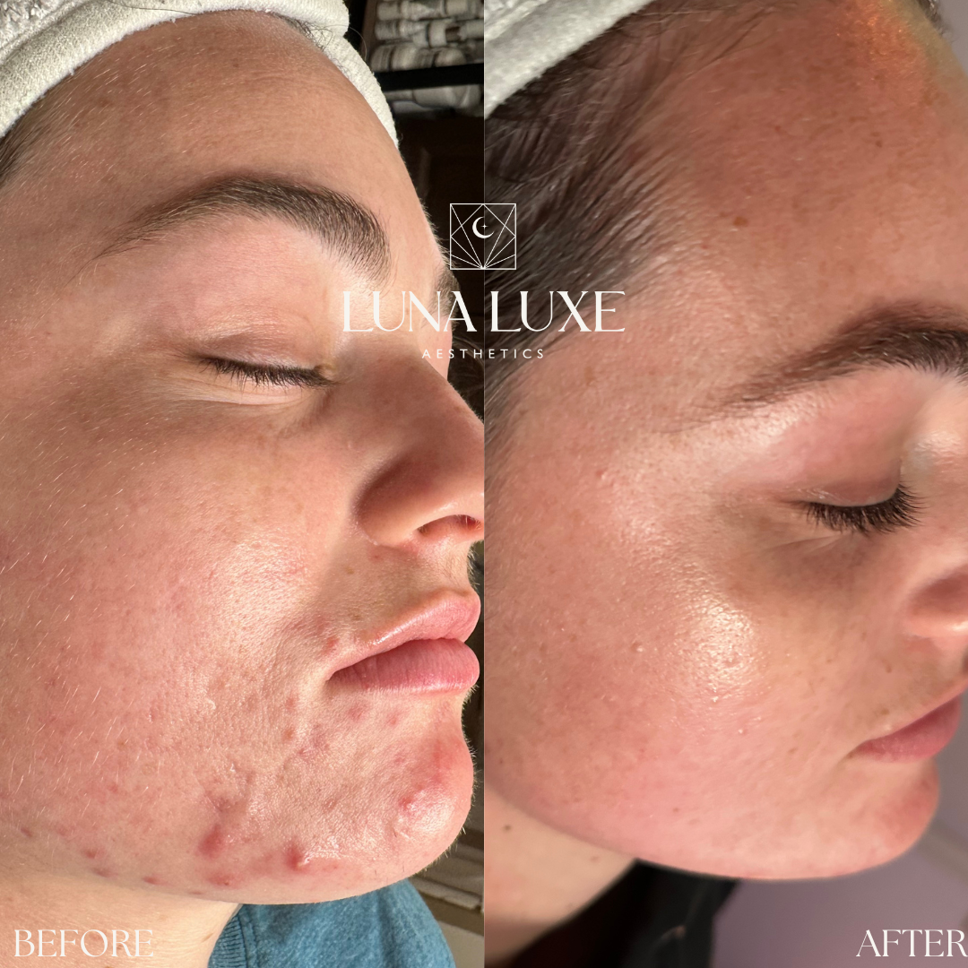 Acne Before & After