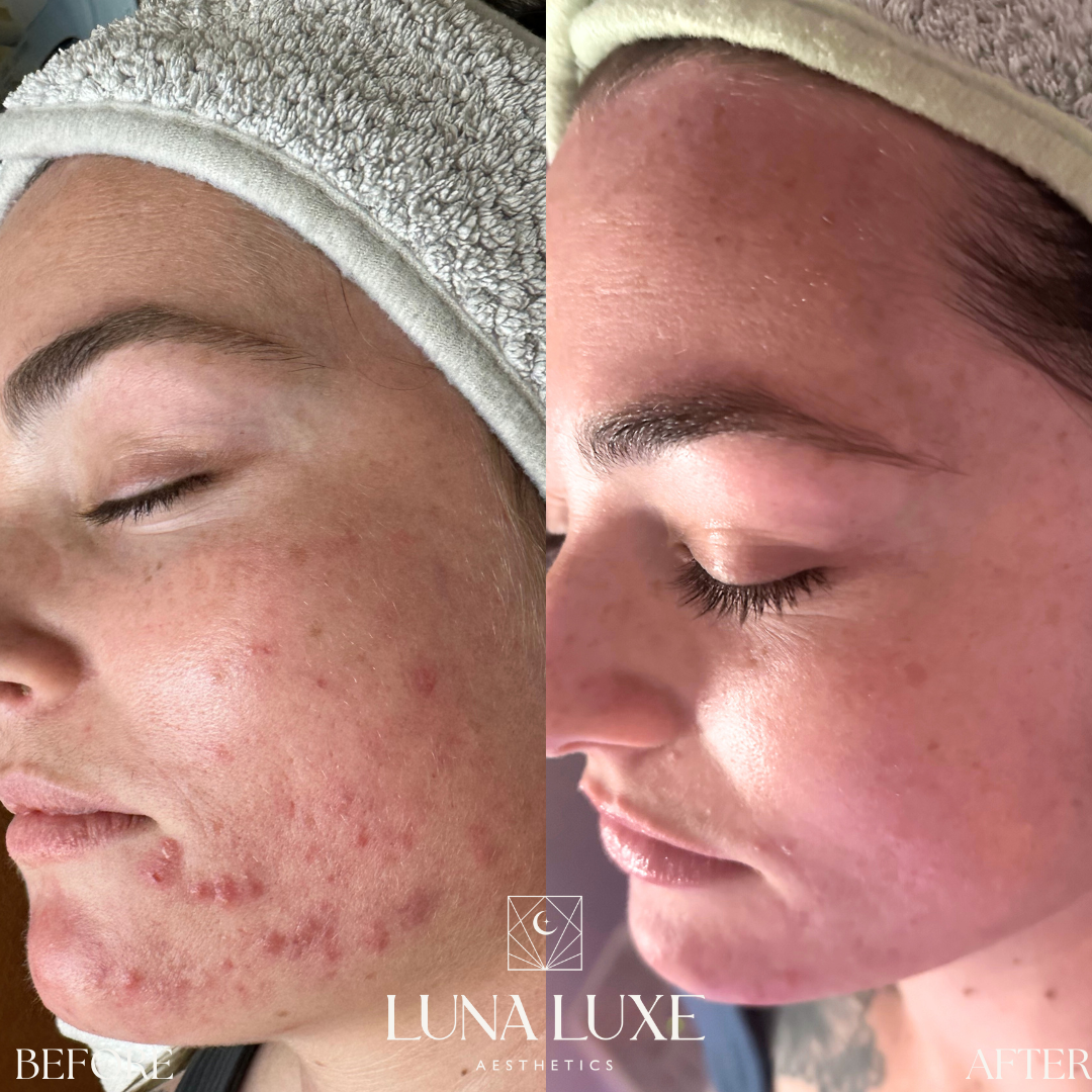 Acne Before & After