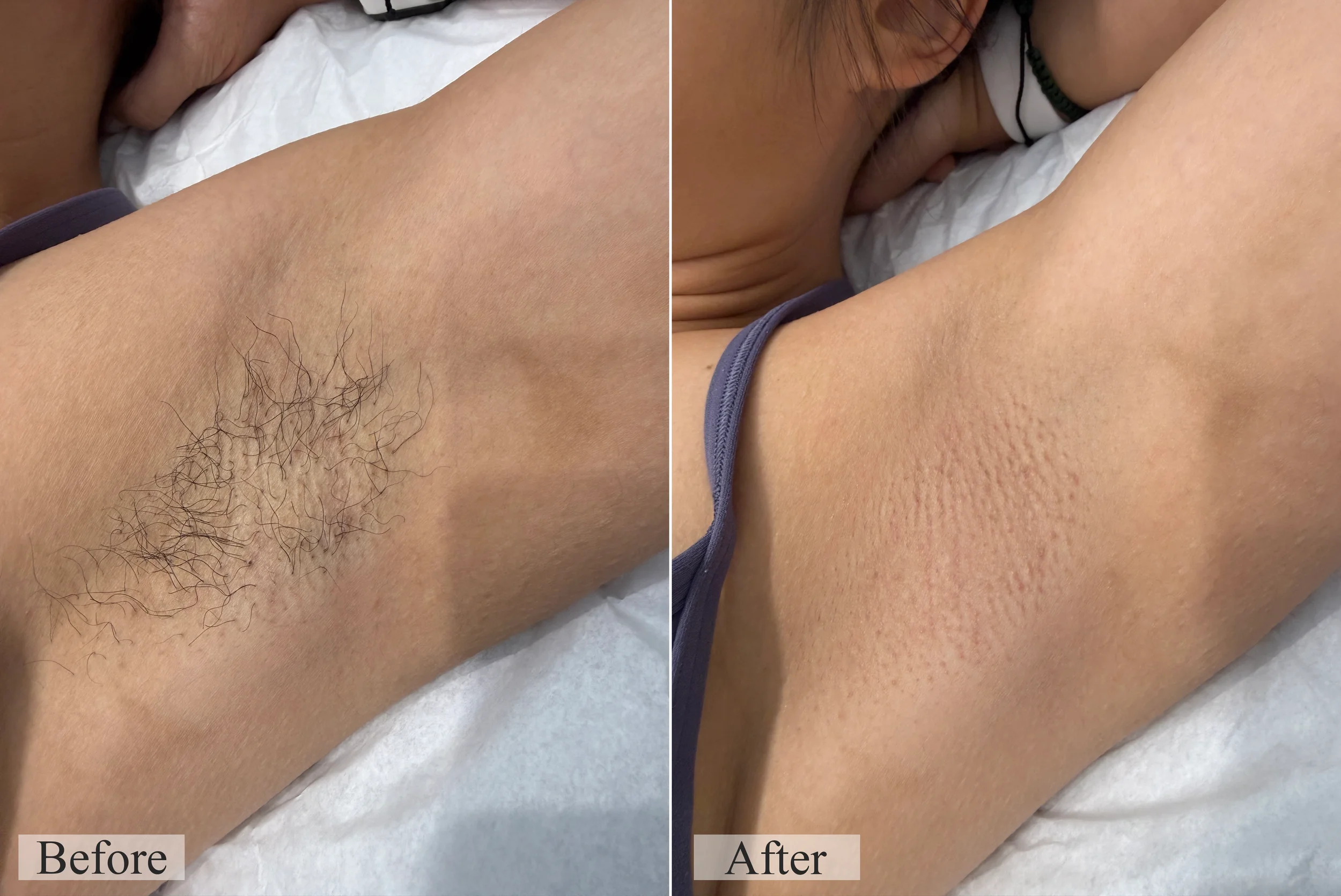 waxing arms before and after