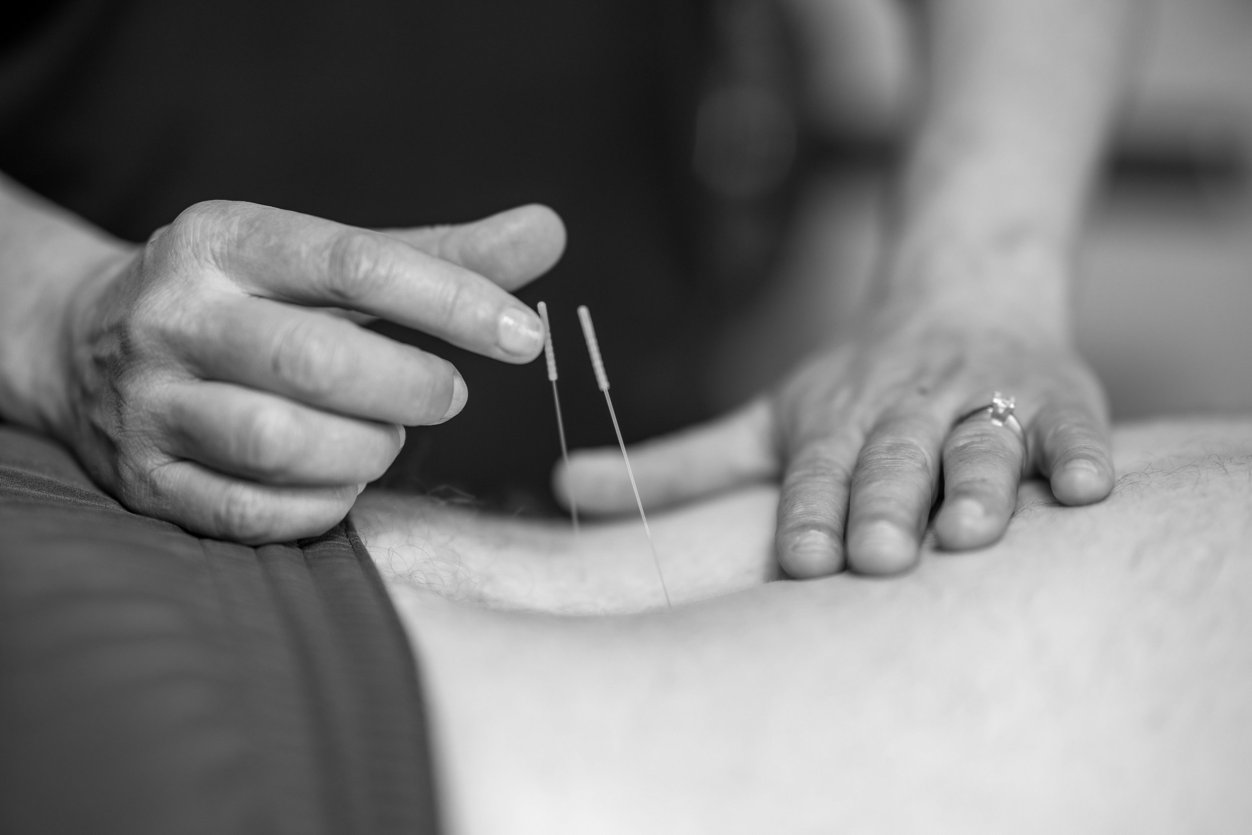 Physical therapist performing needling techniques on patient's back.