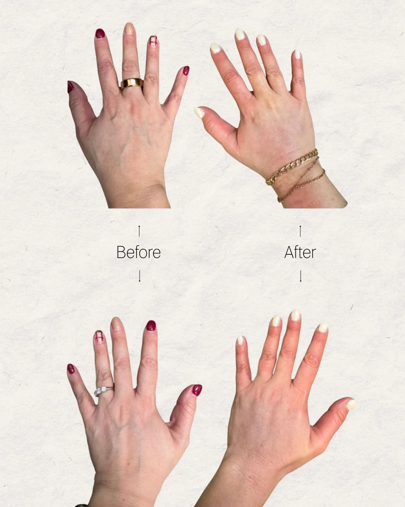 Many notice signs of aging on the face, but what about other areas of the body? This combo treatment of Radiesse and hyaluronic filler makes for immediately smoother &amp; softening of the hands 💅✨🤍

&bull;
&bull;
&bull;
medspa owner, Toledo medspa