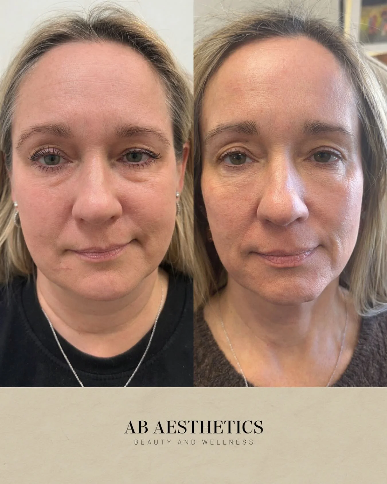 Glow up by AB Aesthetics ✨ Here&rsquo;s what a RadiantLift, regular Botox, a little filler and weight loss looks like. Results that look natural take time - and with our patient (who we promise is VERY happy with her results), it took about a year an