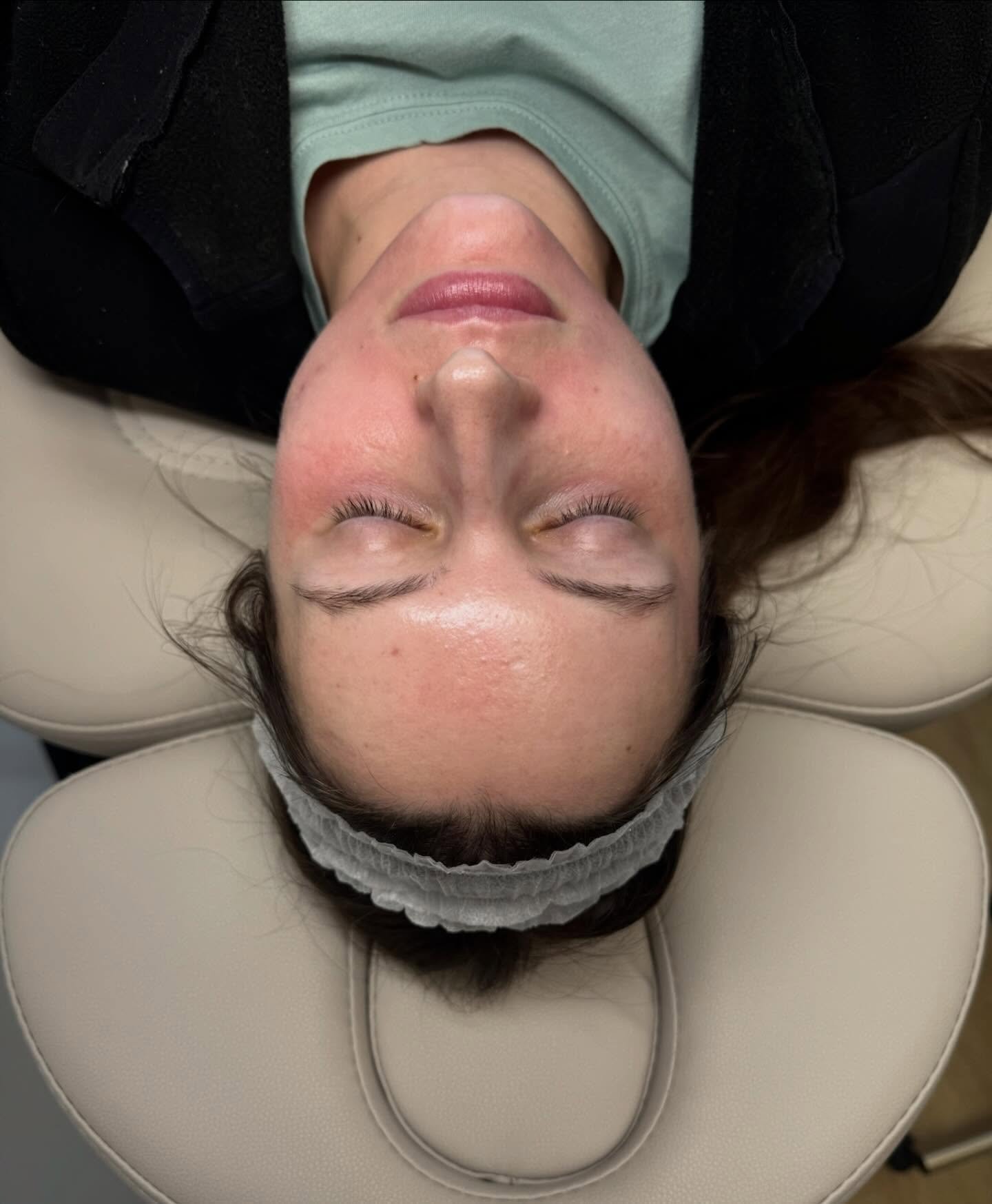 Swipe for the after ✨ Microneedling can soften the look of fine lines and improve scar texture. Glowy, refreshed skin starts with finally booking the appointment&hellip; so take this as your sign to 😉

&bull;
&bull;
&bull;
Microneedling in Toledo, n