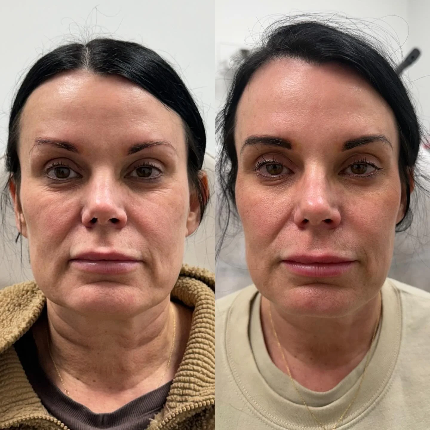 The transformation 👏 This is what Radiant lift + cool peel can do for you too!

Don&rsquo;t forget to check out the March specials! When they&rsquo;re gone, they&rsquo;re gone&hellip;