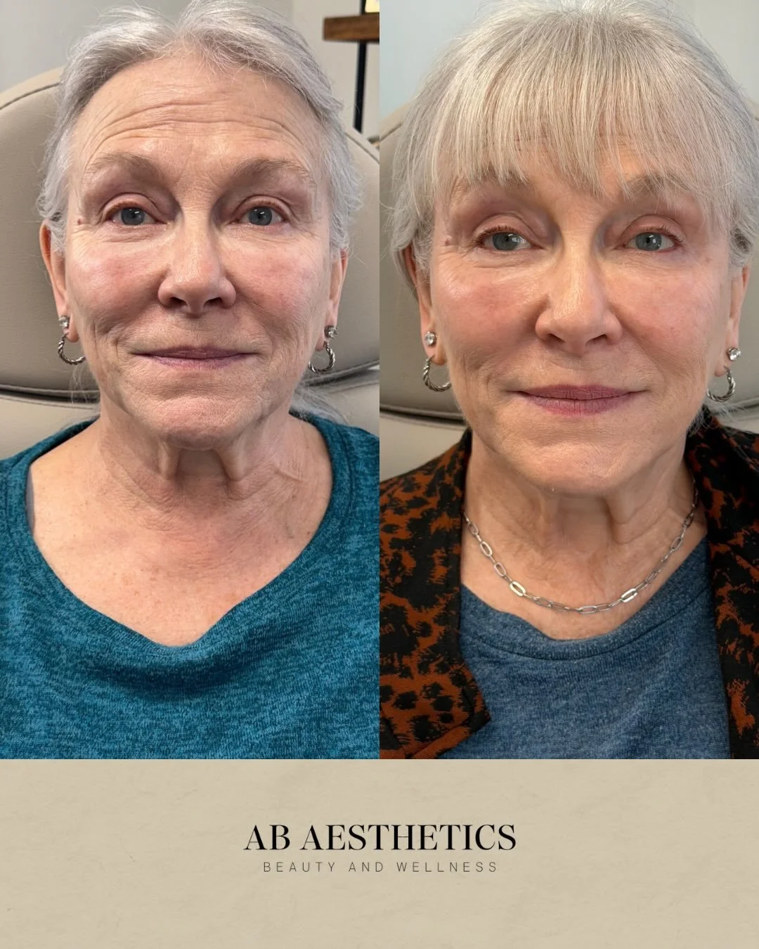 Patient transformation! Here&rsquo;s a little before + after of 4 syringes of Radiesse 4 weeks later 💉

Why do we love it? It gives immediate volume and long term collagen support. If you&rsquo;re looking to reduce the appearance of your smile lines