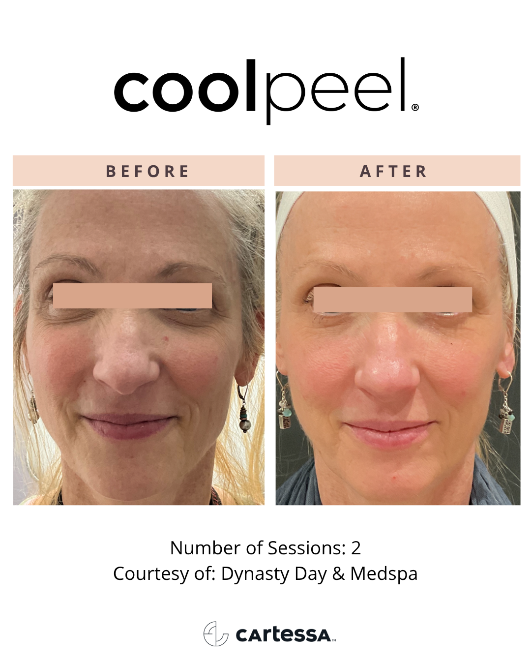 cool peel aesthetic laser treatment in toledo whitehouse monclova northwest ohio