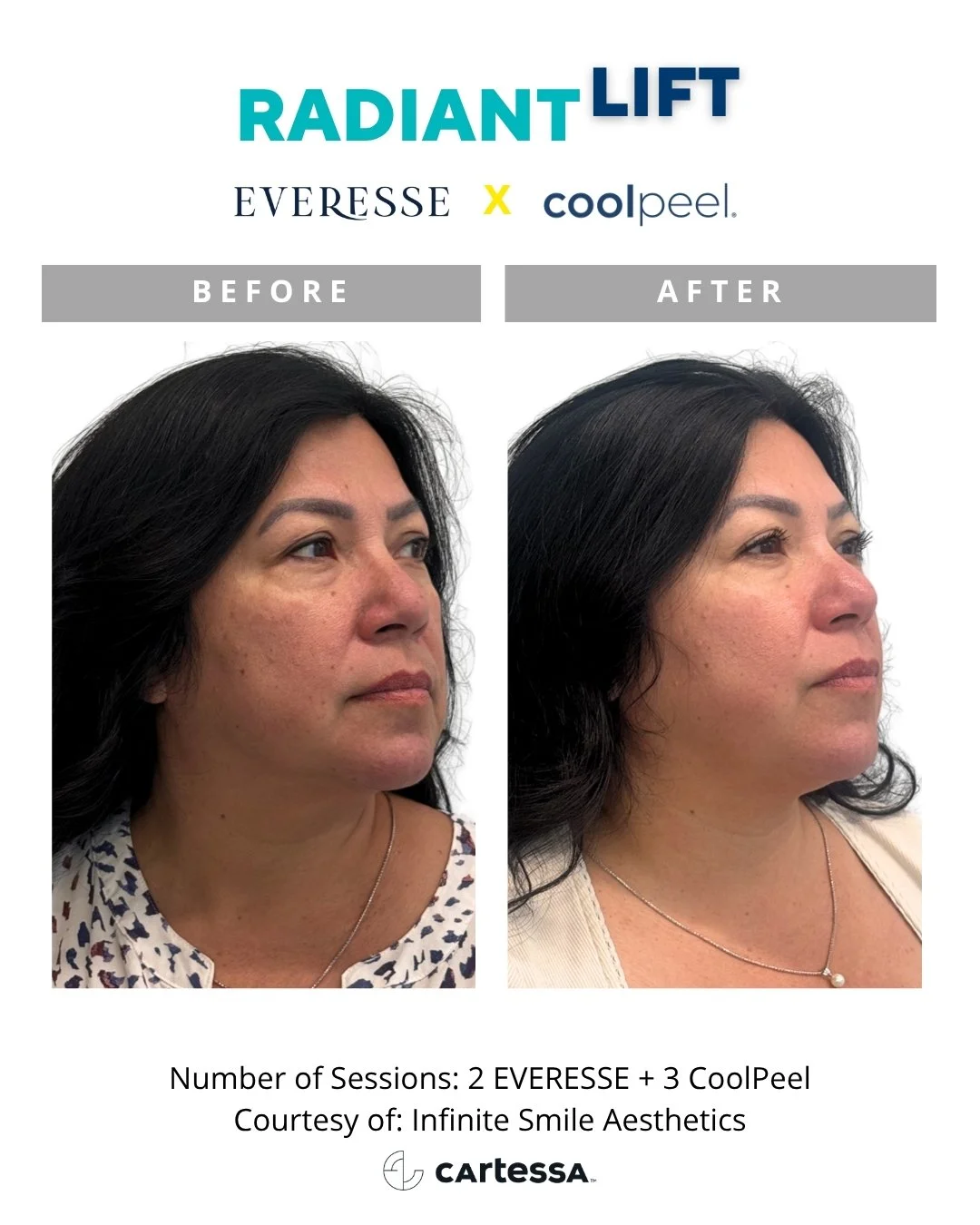 radiant lift aesthetic laser in ohio
