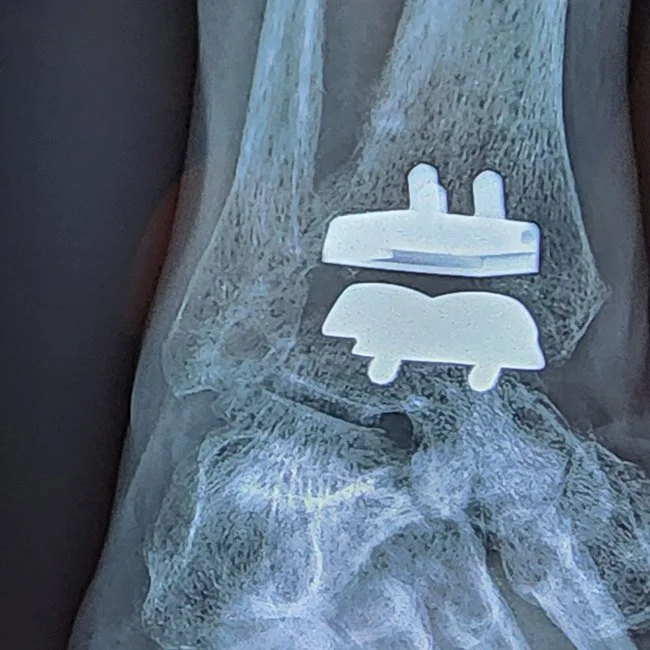 Bunion Surgery — Associate Professor Roderick Kuo – GOXQ