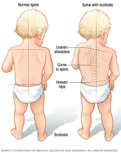 A functional scolosis isn’t as bad as this child. But it shows you the changes that happen in a body if there are twists and side bends.