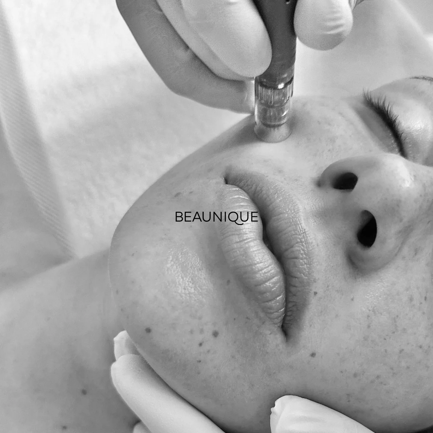Microneedling is not about instant results.
It&rsquo;s about training the skin to regenerate.

By creating controlled micro-stimulation, the skin is encouraged to produce collagen and elastin over time. When done consistently, this process supports h