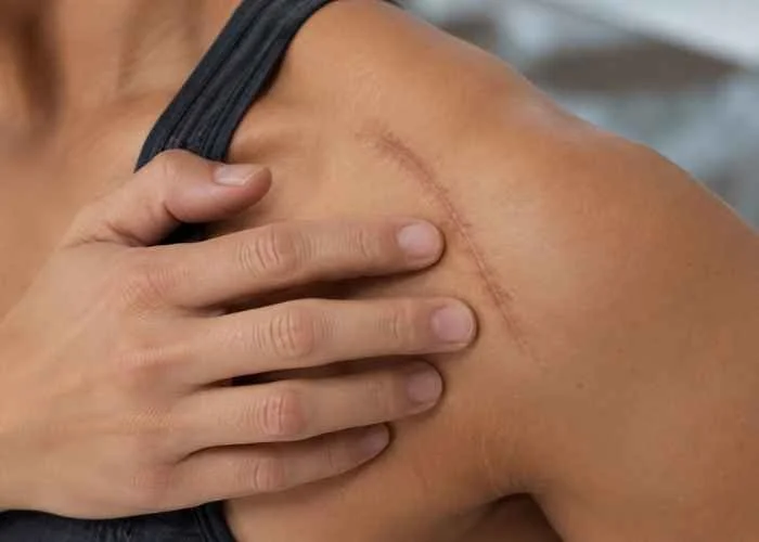 Patients With Scar Tissue