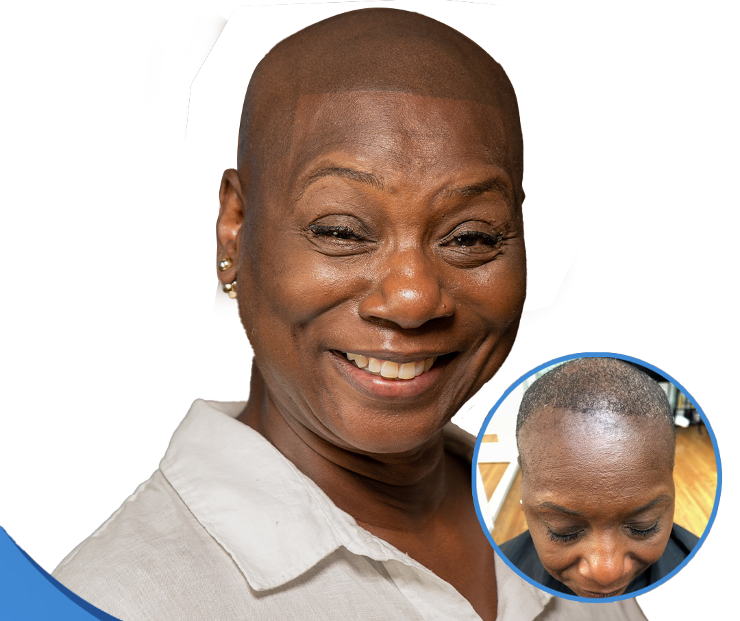 Women Hair Loss — Gerow Hair Ink