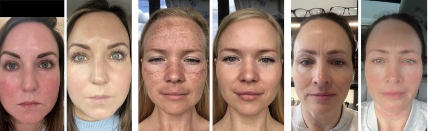 A collage of seven images showing the progression of a woman's facial skin condition, from redness and irritation to clear skin.