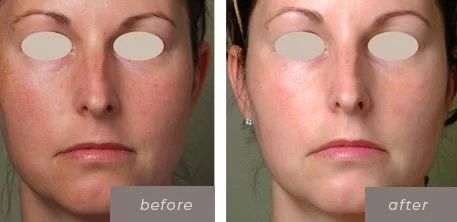 Comparison of a woman's face before and after a skincare treatment, showing reduced redness and clearer skin.