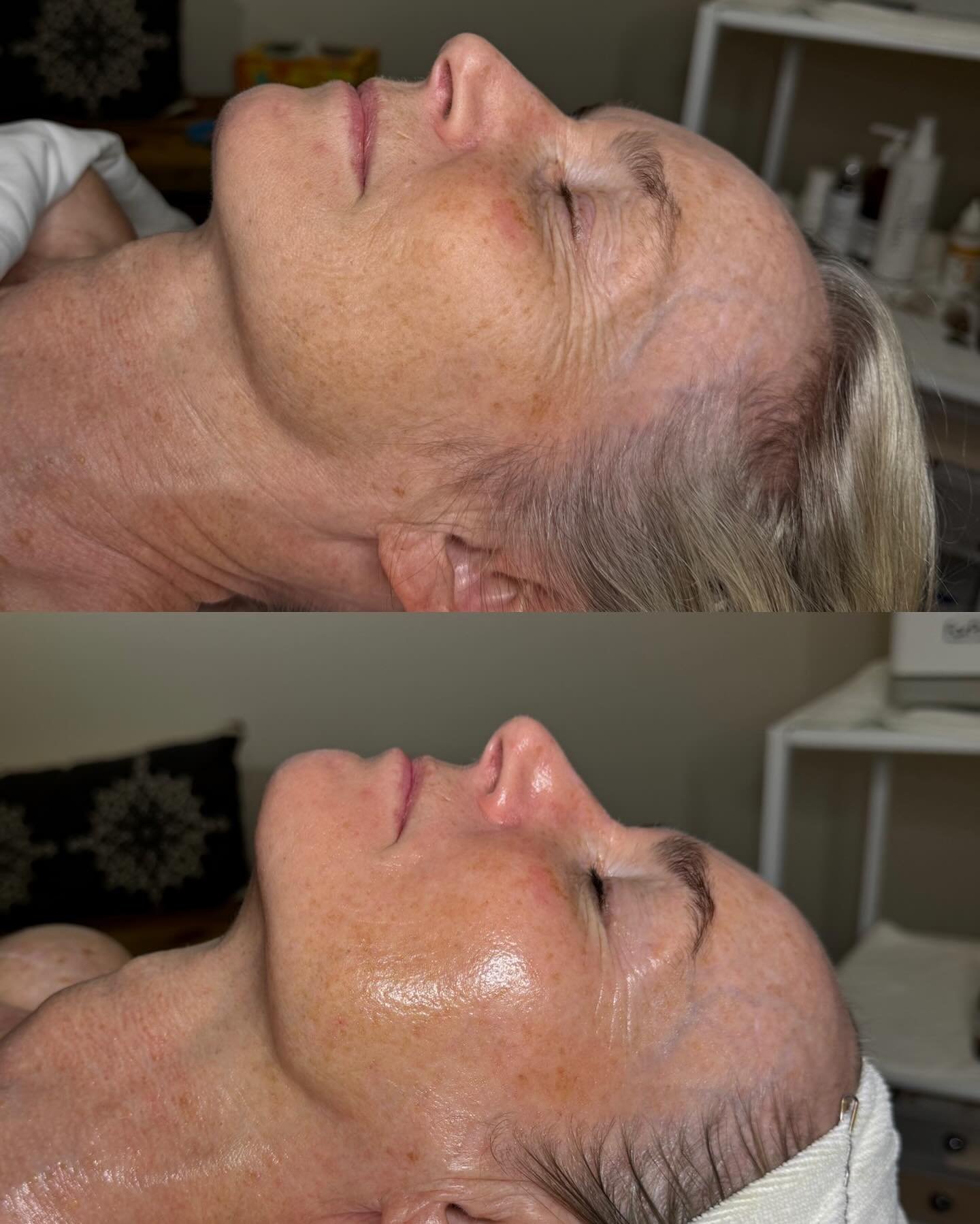 One Signature Facial 💕 using Ultraceuticals clean cosmeceutical grade skincare and an added red light therapy session. 

Are you ready to book? 

These results are amazing 🎊

#heidilaneesthetics #ultraceuticals #boiseidaho