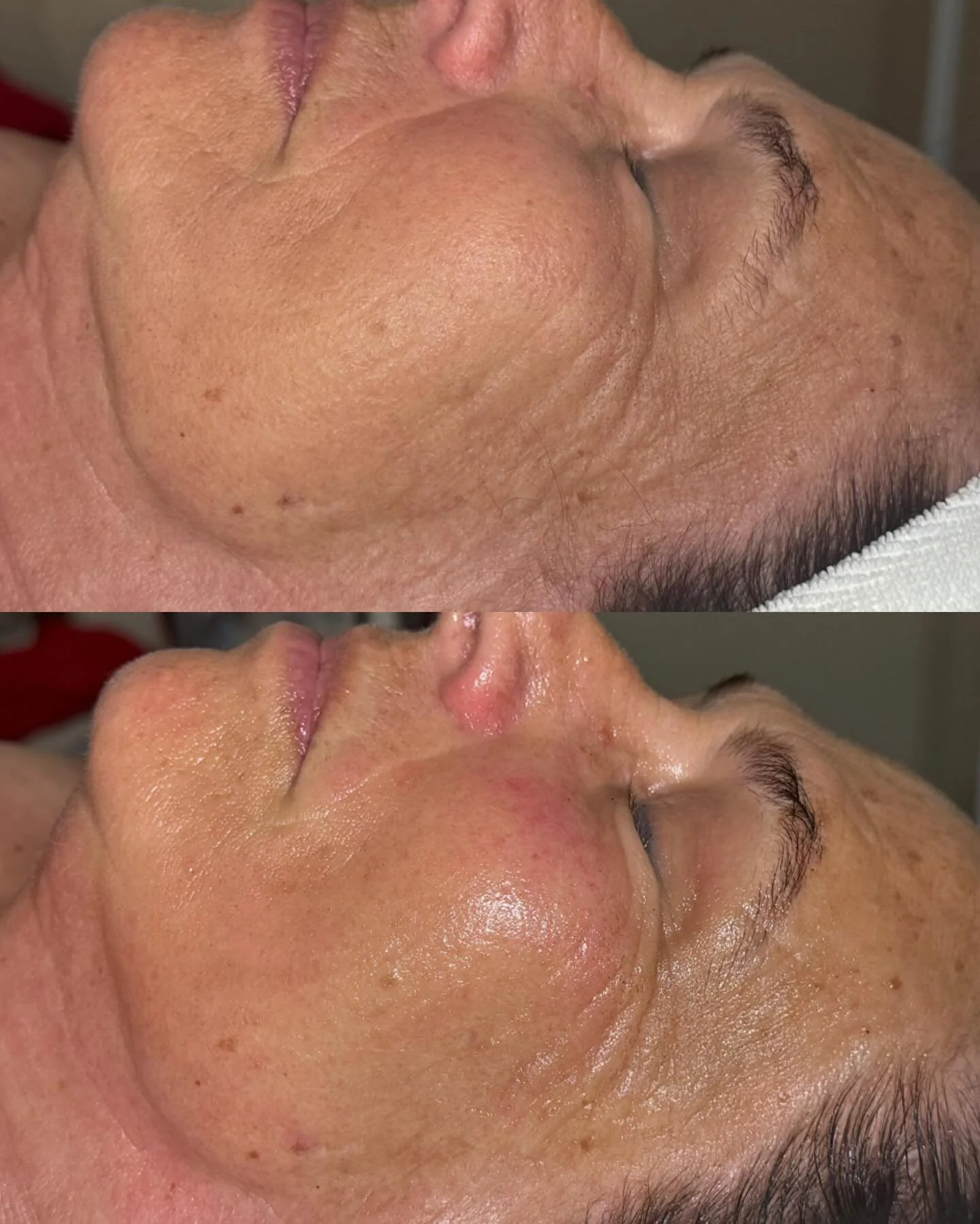 Microcurrent Facial 💪Before and after 🍃 Firms, tones and lifts the skin.

No downtime 🌿 Just gorgeous glowing skin.

#heidilaneesthetics #boisespa #microcurrentfacial #faceworkout #naturalfacelift
