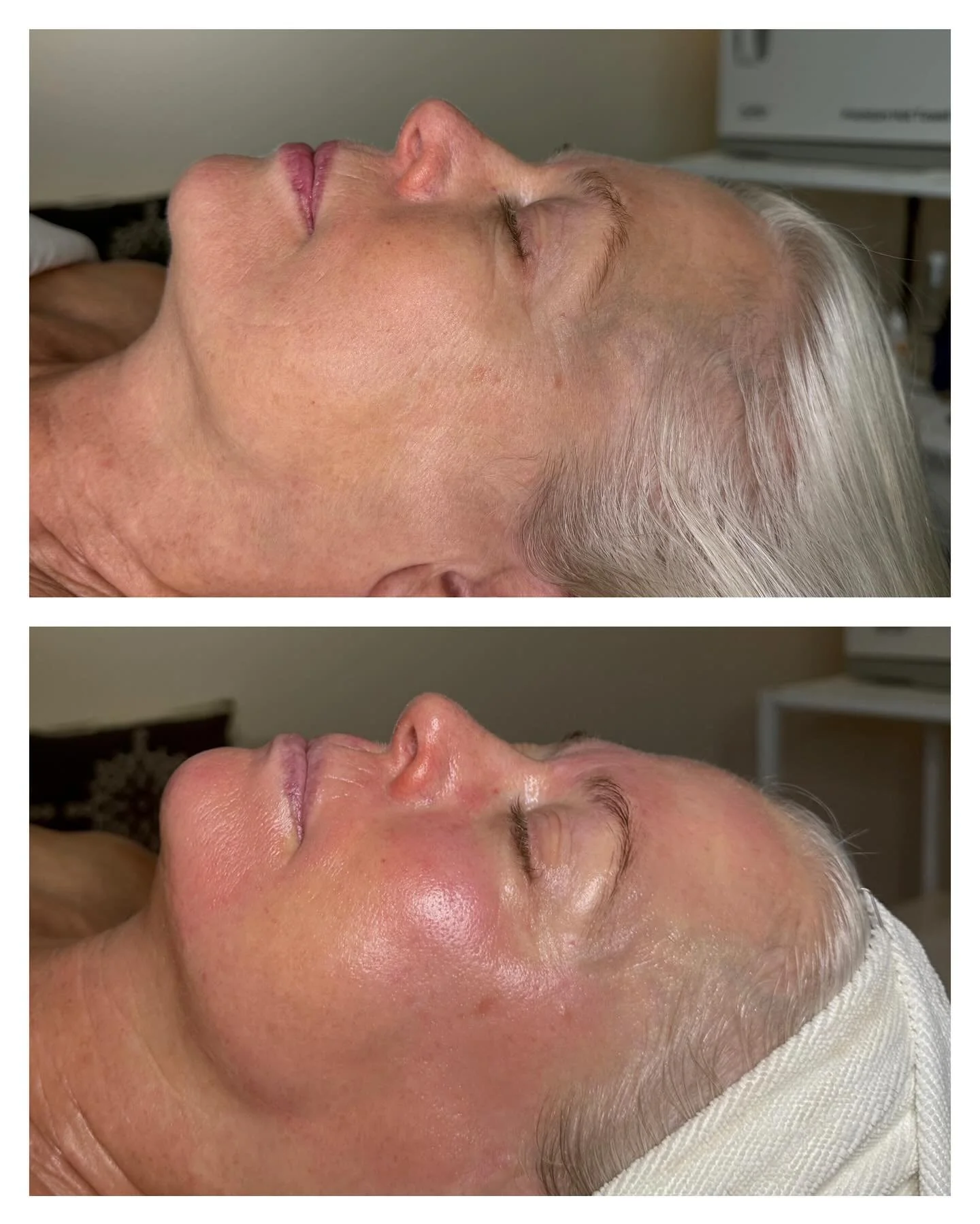 Transformative facial 💕Before &amp; After microneedling🍃

We added an eyebrow wax &amp; eyebrow tint to this facial and included dermaplaning to remove peach fuzz hair.

Microneedling benefits include:
Collagen boosting 
Smoothing texture
Skin reju