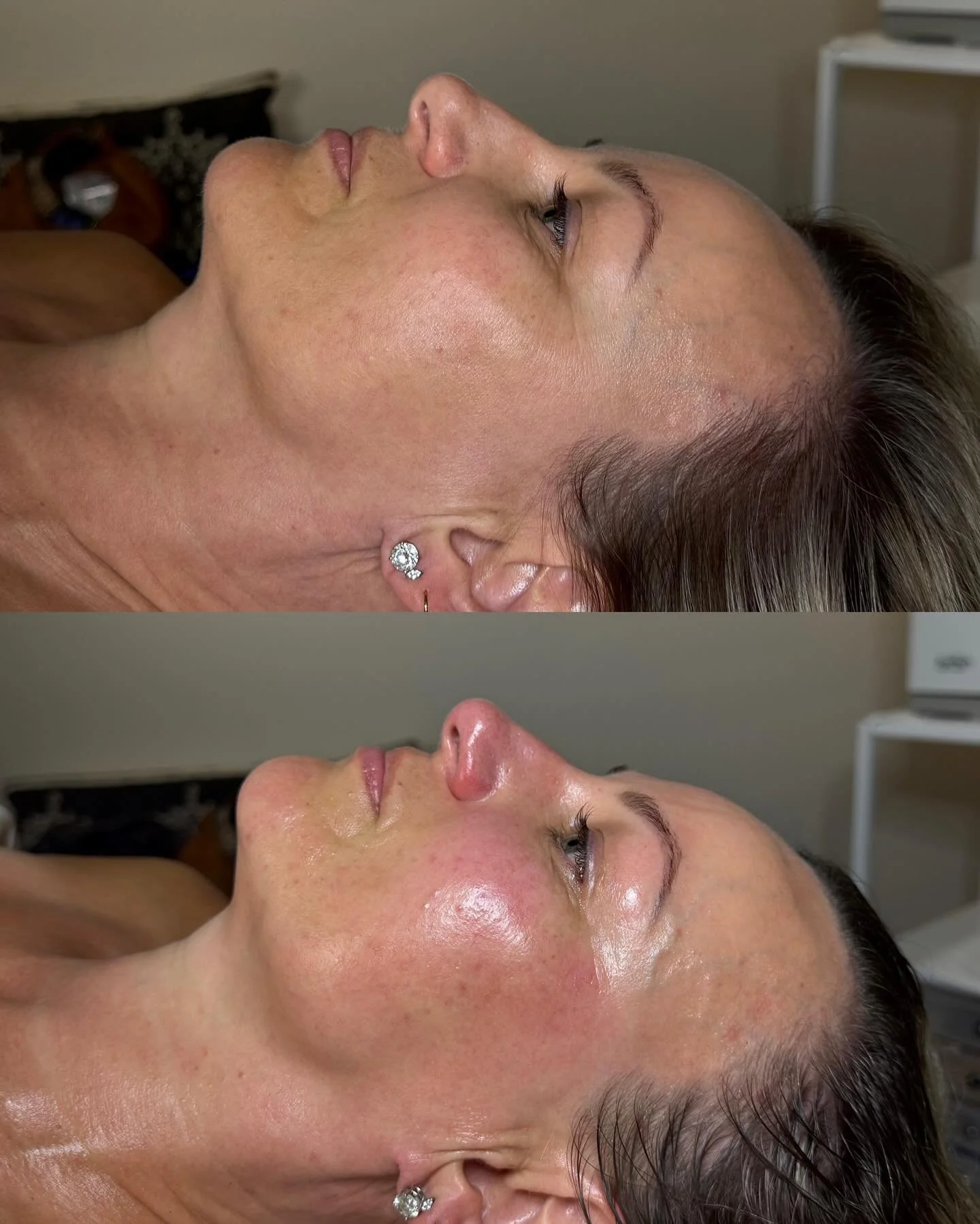 Tighter, Brighter 🌟 plump glowing skin 💕 Before & After 🍃 Signature Facial.
Our Signature Facial Includes:
Customized chemical peel 🍂We used the Ultraceuticals Lactic Acid peel for this client and mixed with a few booster serums for a more e
