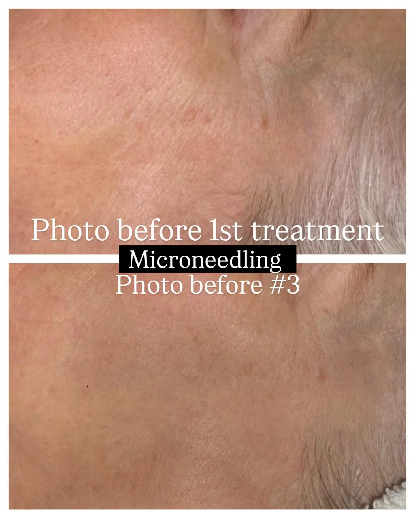 Transformation in progress 🙏Swipe through to see before and afters with a 3 session micro-needling series.

Client has less wrinkles &amp; crows feet ✔️
Firmer tighter skin ✅
Jaw line that is getting more sculpted by the session ✔️
Skin is vibrant a