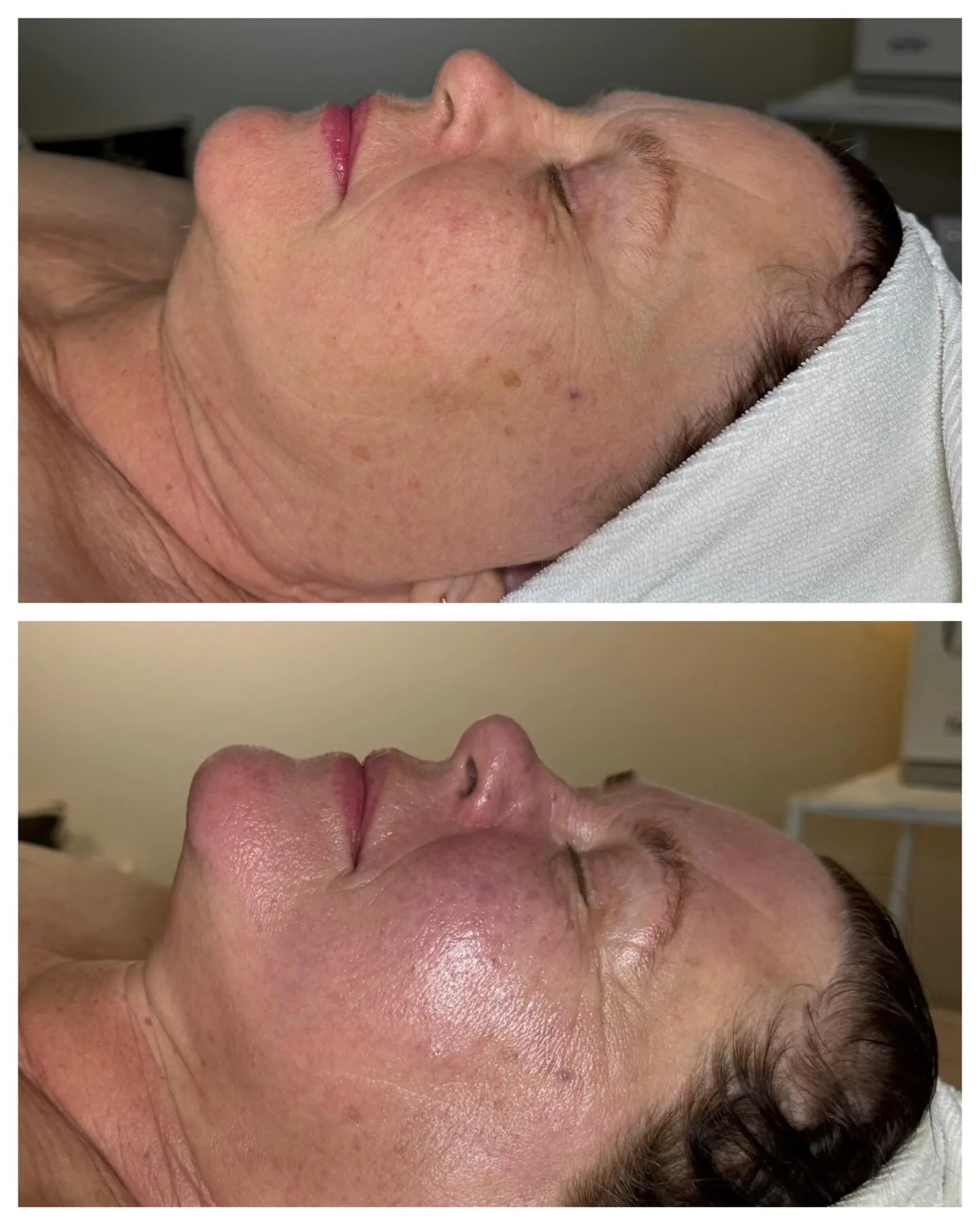 Fresh glow for the holidays 🌟 This client received a brightening chemical peel to improve texture and reduce hyperpigmentation 💕

No downtime ✨Visible skin results.

We also added on dermaplaning (complimentary with our Signature facial) and an eye