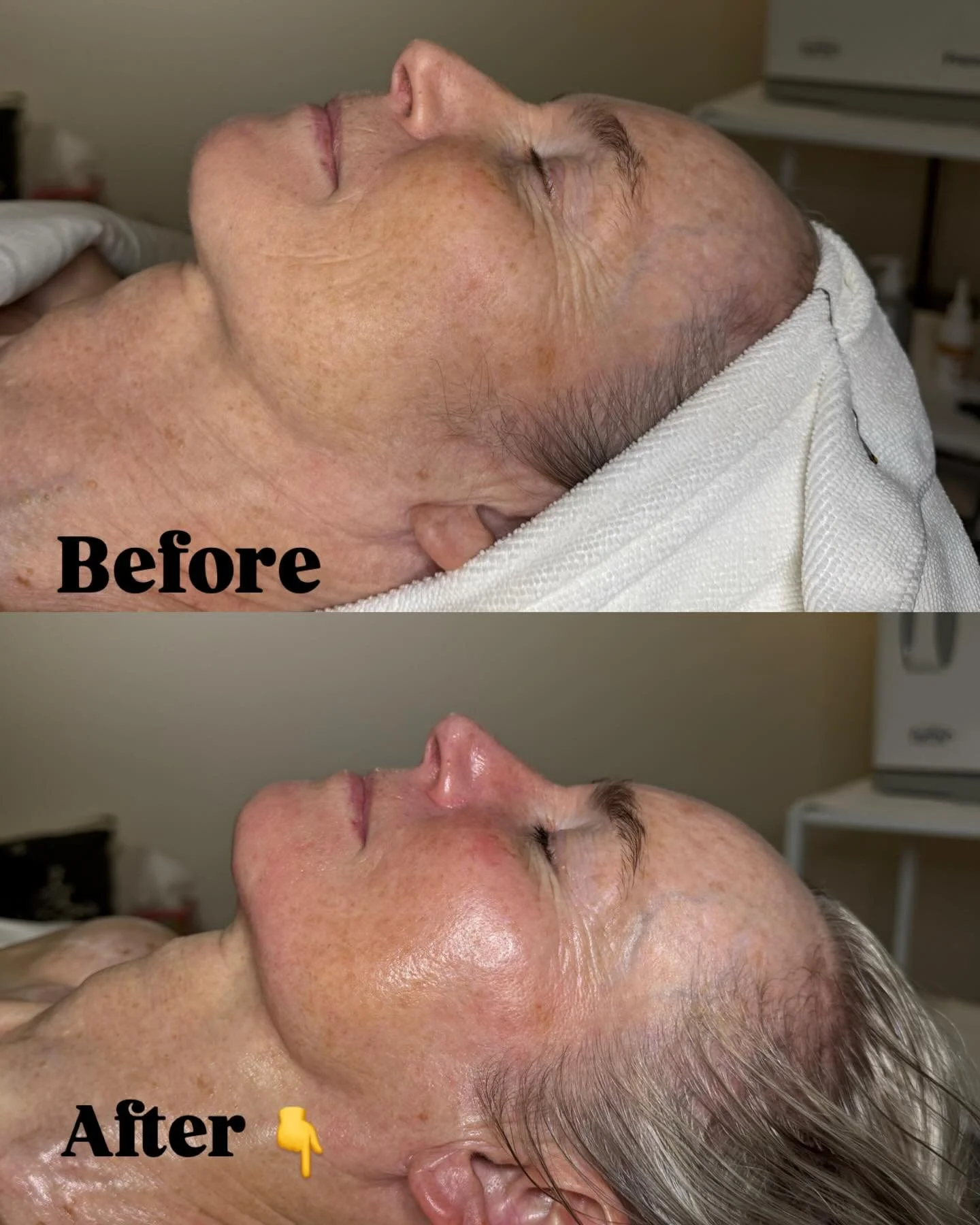 Ultra A-zyme corrective facial (Retinol + Enzymes) 🤩

Before:
Dehydration
Dullness 
Texture 

After:
Brighter firmer smoother skin 💕☀️

One facial 😍No irritation- Just real results.

Book your A-zyme facial today!

#heidilaneesthetics #ultraceutic