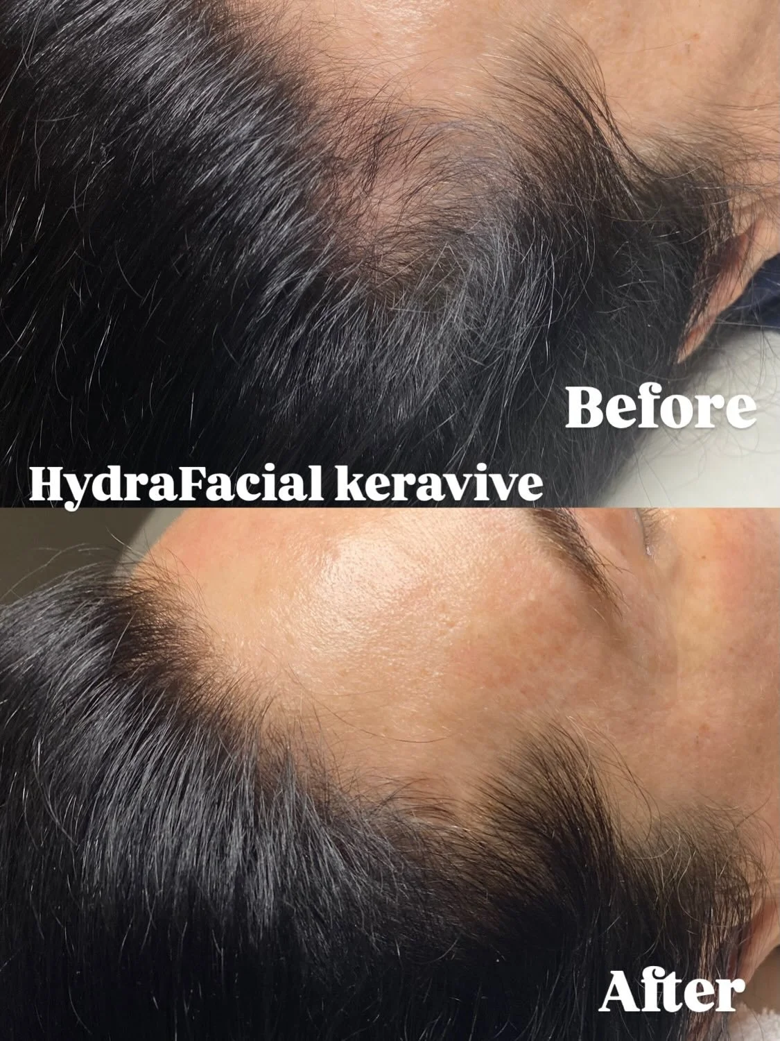 HydraFacial Keravive hair growth treatment 💦Before and After 30 days✨ 

If you struggle with thinning hair book your appointment today💕

#heidilaneesthetics #hydrafacial #hairgrowth #boisehair #boiseidaho