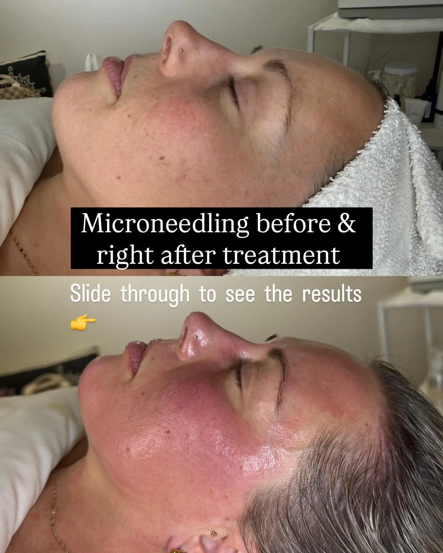No makeup 💕 No filter ✨Just real microneedling results.

Book your facial today ❤️

#heidilaneesthetics #boisemicroneedling #boisespa #boiseesthetician #boisemedspa