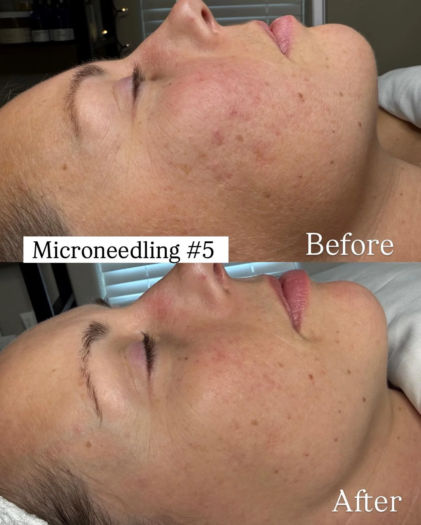 MicroNeedling results ⭐️ Real Skin Transformation ✨

🌸 Acne scars visibly softened 
✨Redness gone
🌸 Texture is smooth 

$205
Book your micro-needling facial today at Heidi Lane Esthetics.
Healthy, radiant skin starts here ✨

#heidilaneesthetics #bo