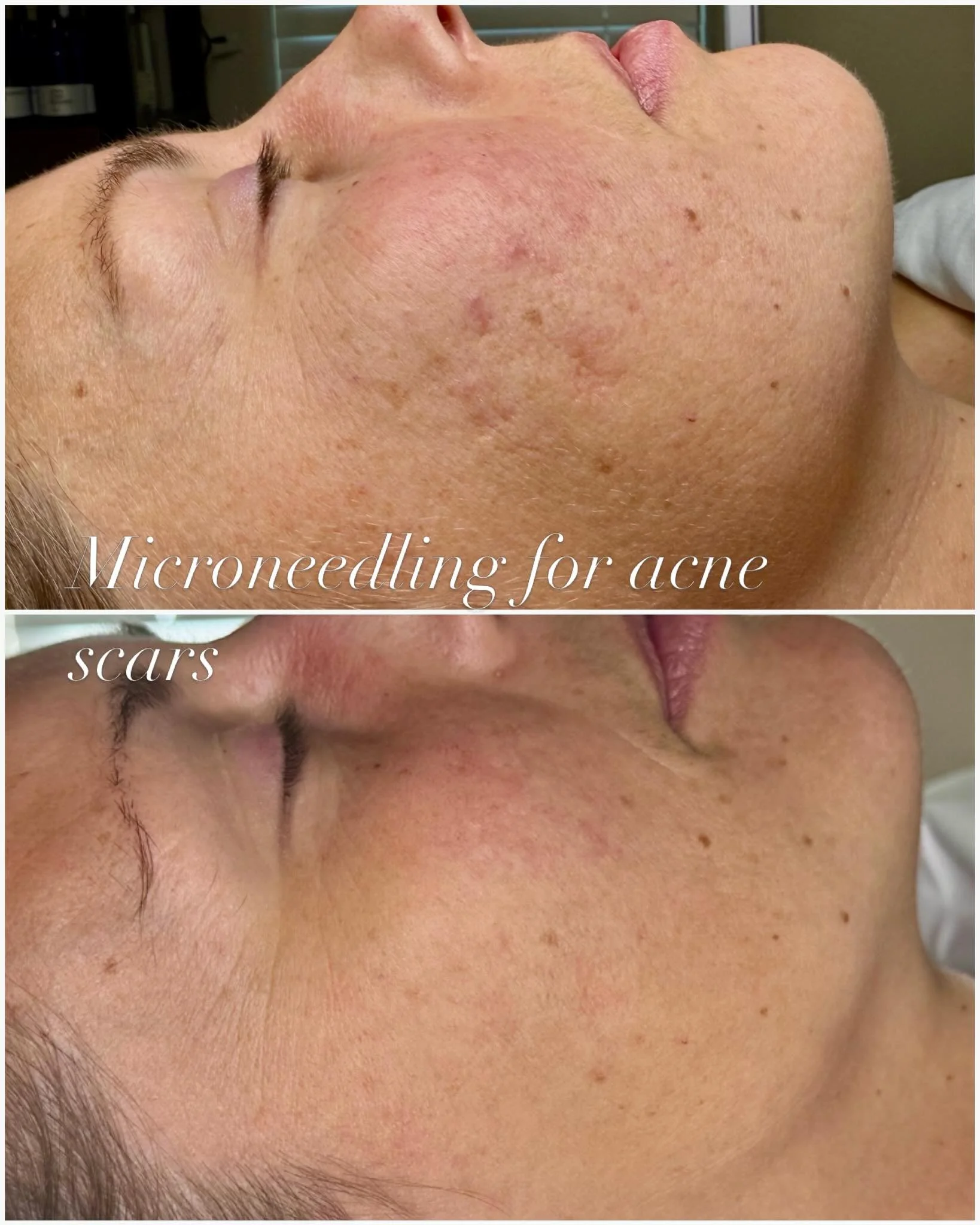Acne scars don't have to be permanent ✨

This is a series of 6 micro needling treatments &amp; the change is significant ✨ What was once pitted, uneven texture is now smooth, refined and barely noticeable.

MicroNeedling works by stimulating collagen
