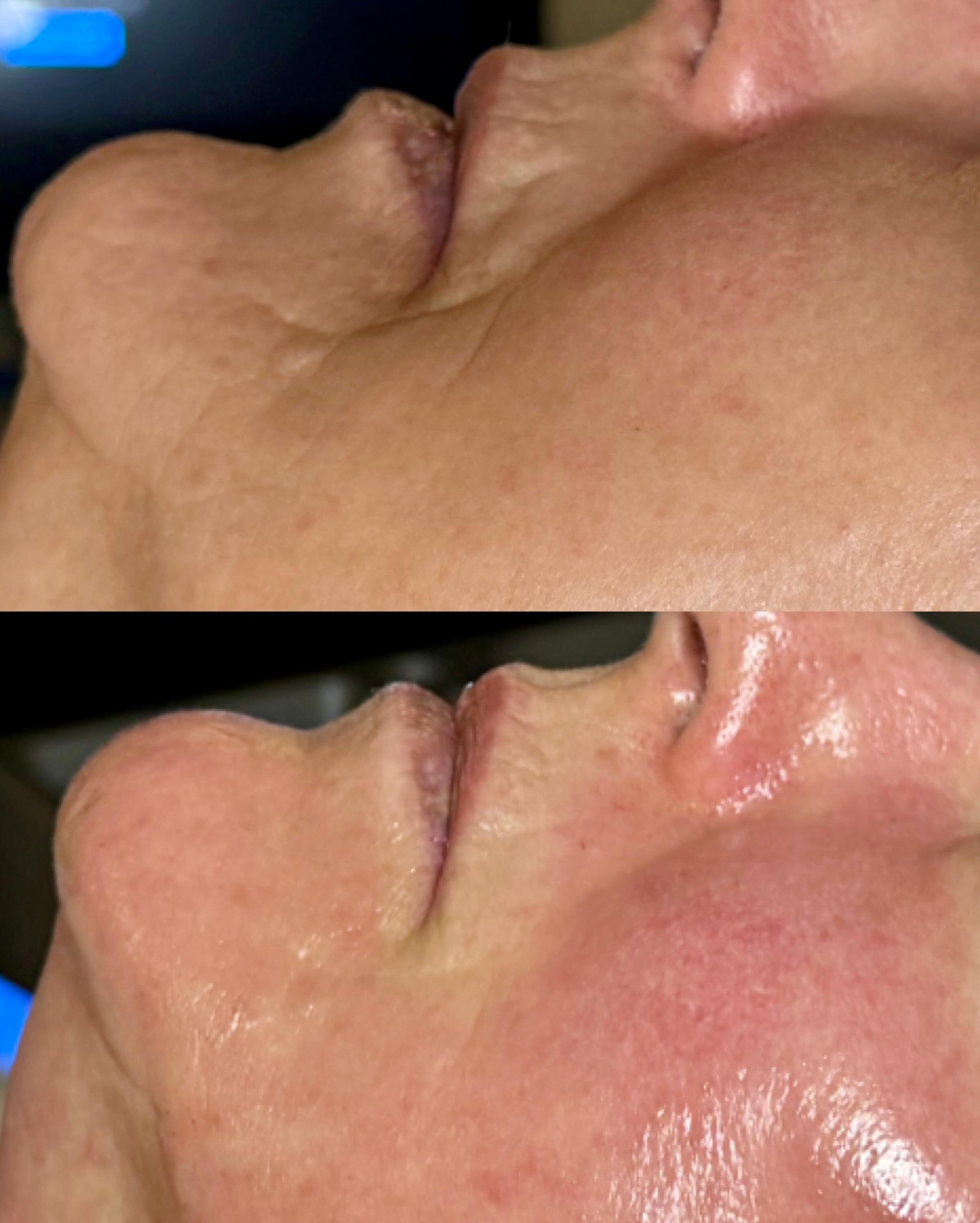 HydraFacial + Micro needling add-on ✨ One treatment✨ More than a facial ✨

Before &amp; After 🌟
✔️ Smoother texture
✔️ Healthier skin
✔️ Visible rejuvenation

Why this combo works👇
✨HydraFacial deeply cleanses, hydrates and nourishes the skin with 