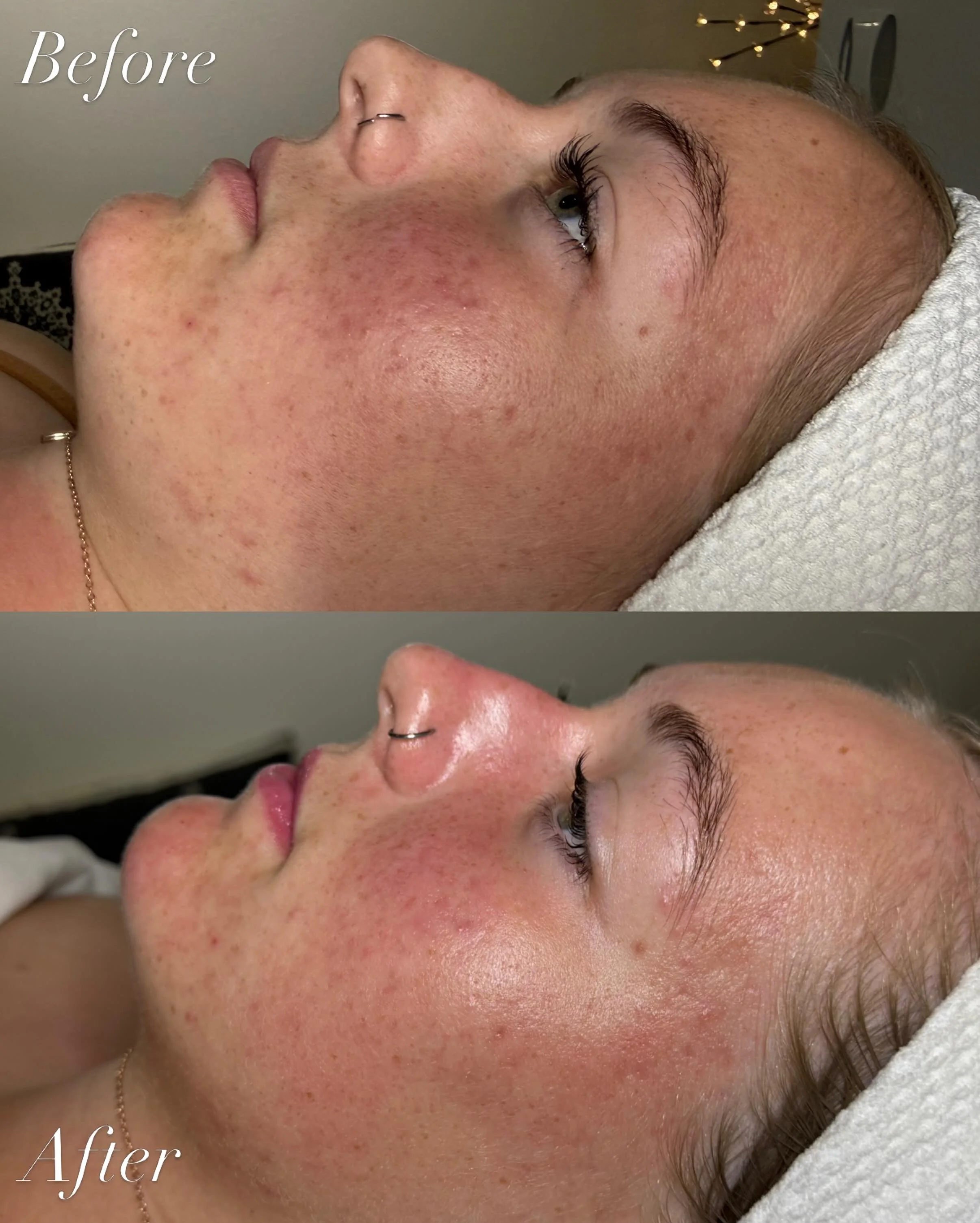 First facial back from college ✨

Today we started this gorgeous athlete on a customized acne treatment plan for the summer ☀️ with corrective peels and a simple at home skincare regimen.

Between stress, travel, late nights 🥱&amp; changes in routin