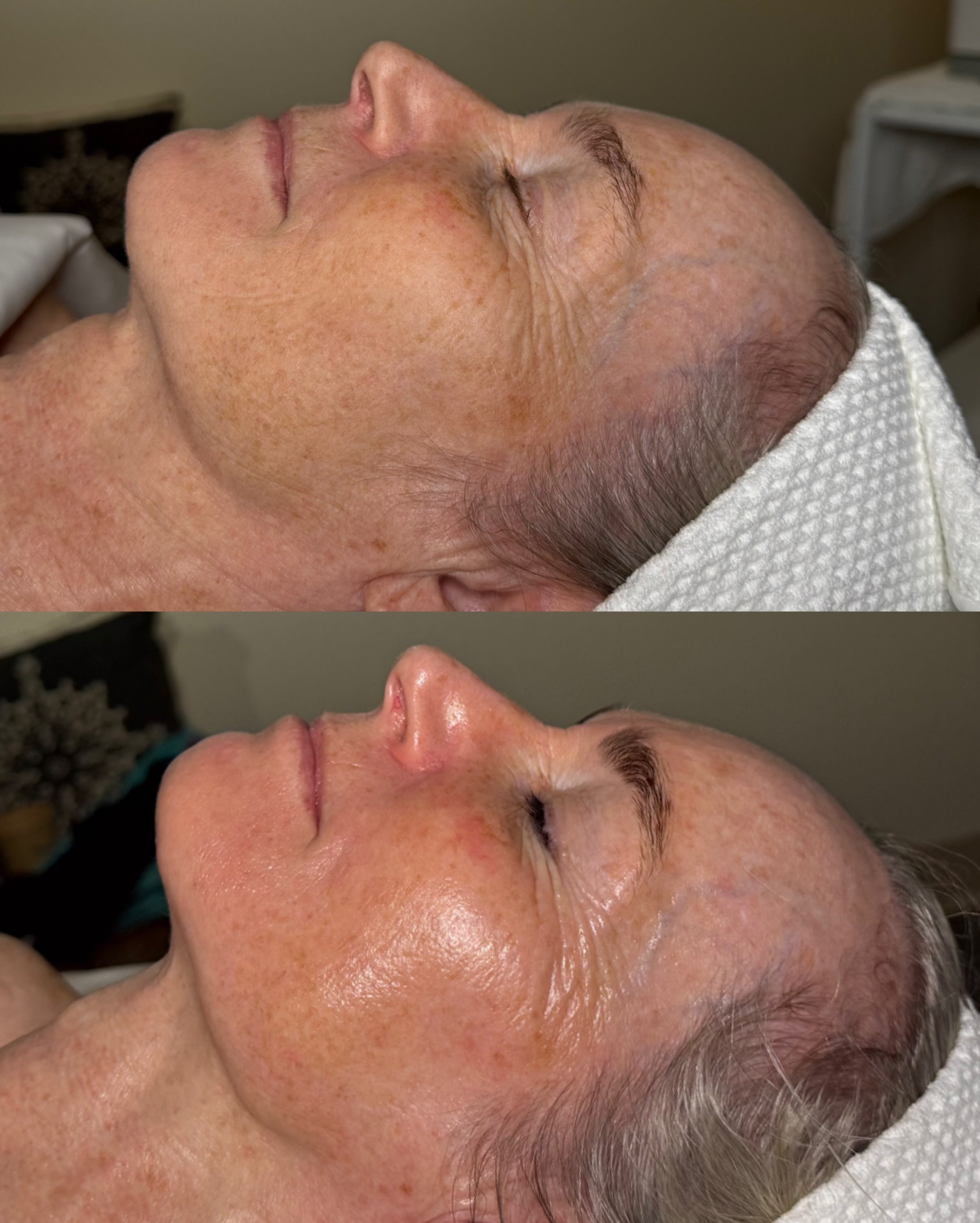 Signature Facial ✨with brightening peel ✨Before &amp; After 💕

Customized to deeply hydrate, replenish and restore glow✨ Dermaplaning included.

Book your facial today 🩷

#heidilaneesthetics #boisefacials #oxygenfacial #epicurendiscovery #boisebrow