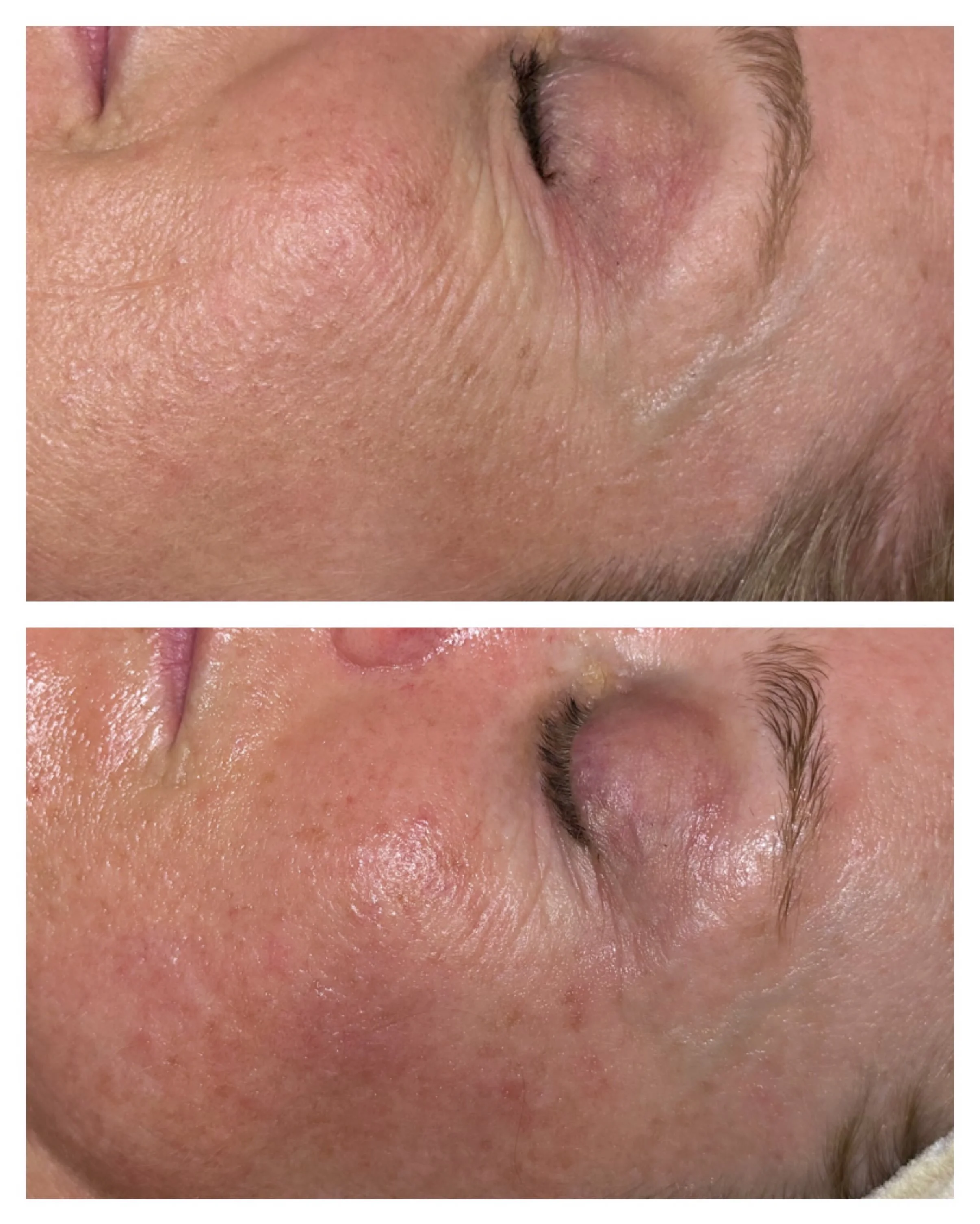 Best combination treatment ✨ Ultraceuticals B2 hydration mask paired with our red light therapy glow nap ✨ 

*Increases moisture by 158% ✨ 
* Red light therapy gives energy to cells for cellular level skin rejuvenation ✨ increases collagen, hydration