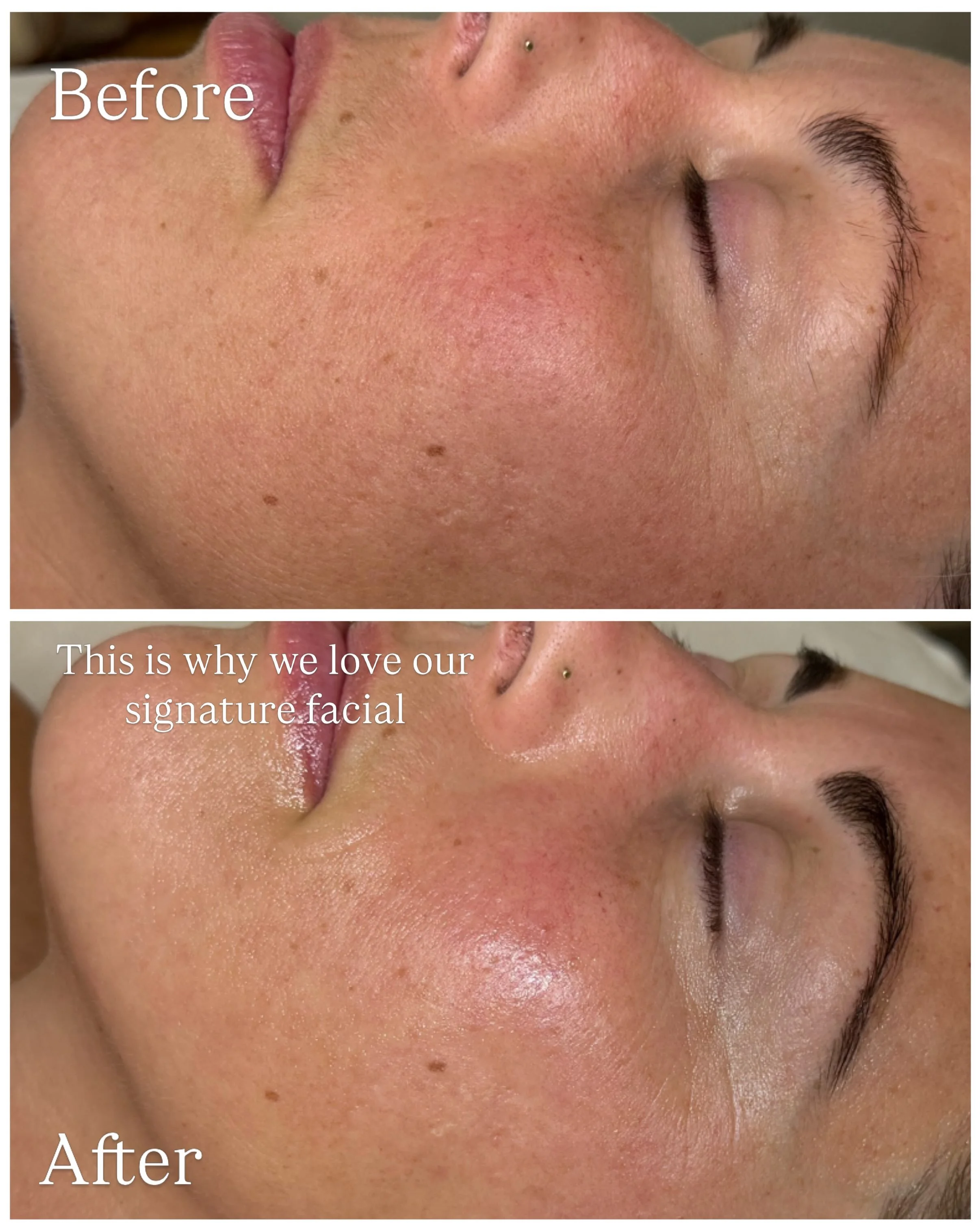 Our Signature Facial comes with a Lactic Acid peel to remove dull surface skin cells, increase cell turnover and maintain results you've worked hard to achieve ✨

The best skin results are built through consistency, maintenance and a personalized tre