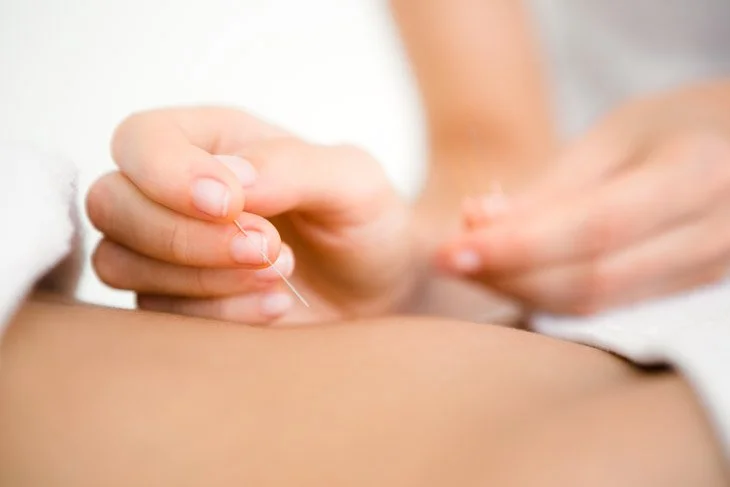 When to Consider Acupuncture for Digestive or Hormonal Issues