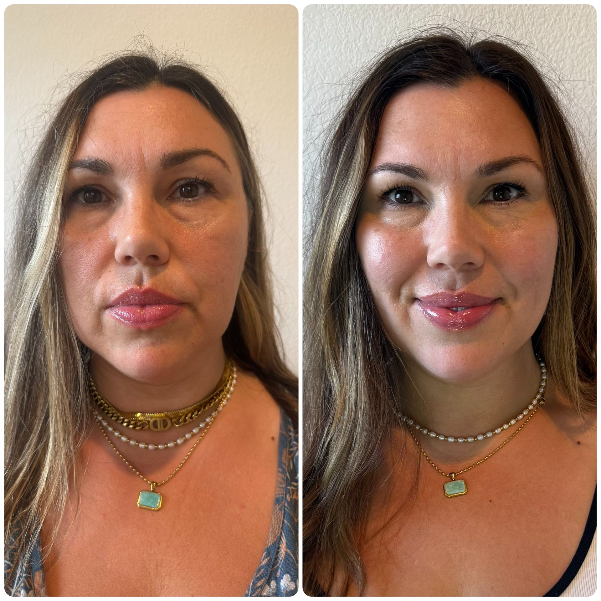 Botox, Voluma in cheeks and Ultra in Lips