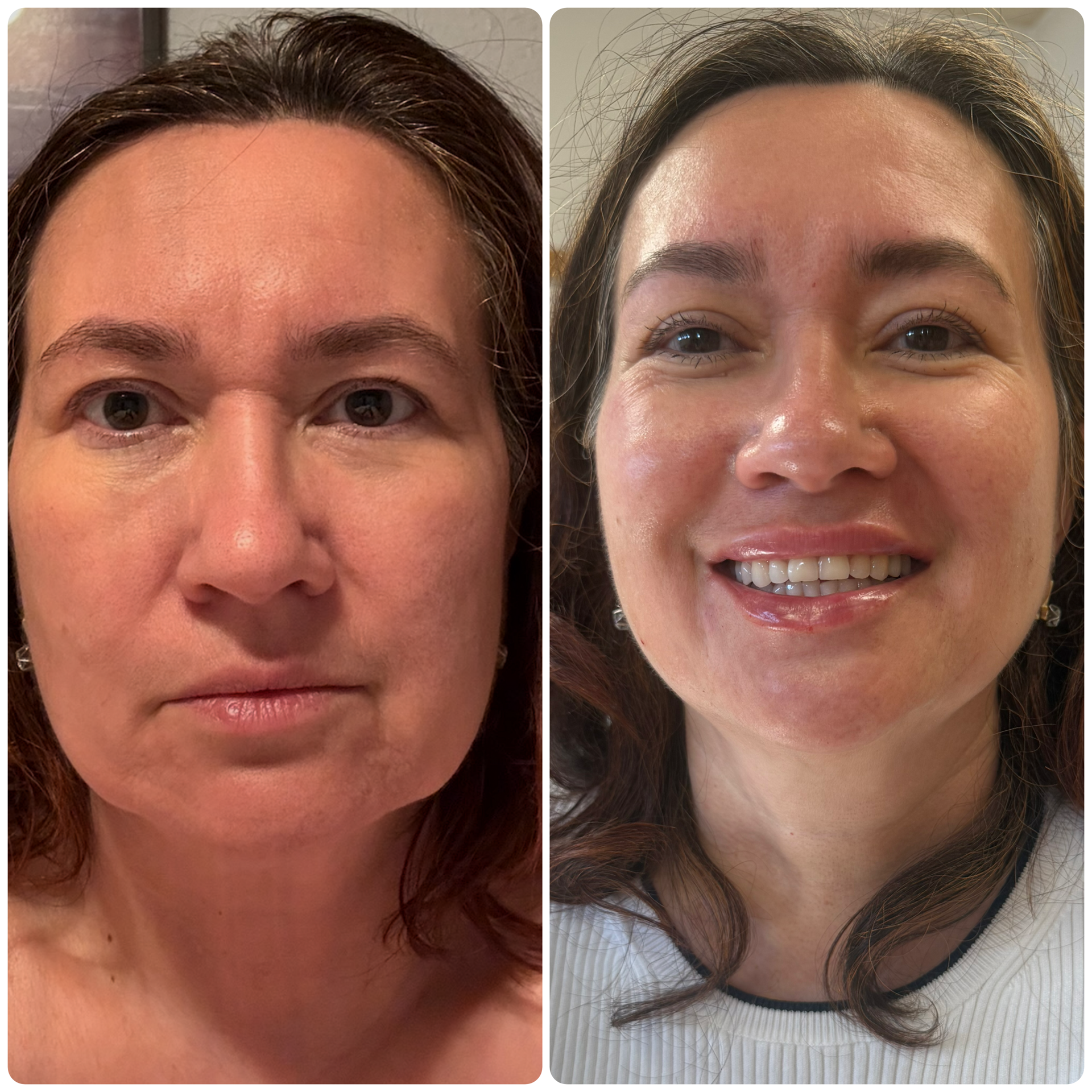 Botox, Sculptra and Kysse