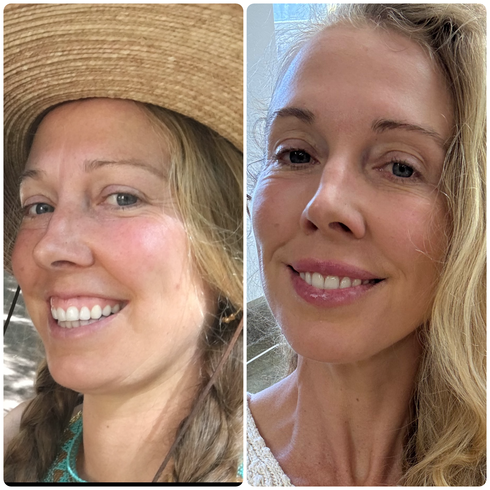 Botox, lip filler, sculptra