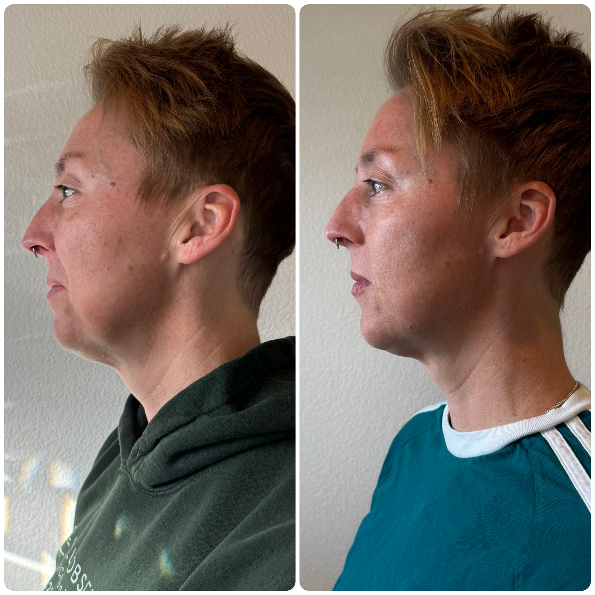 Botox lower face, chin filler
