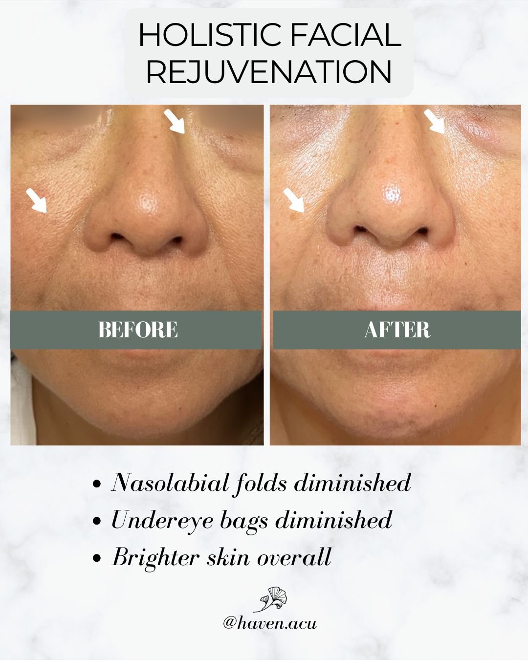 ✨ Smooth lines, lift sagging, and brighten tired eyes, naturally. Cosmetic acupuncture targets signs of stress and aging like nasolabial folds, marionette lines, and under-eye bags by stimulating your body&rsquo;s own healing response. No fillers, no