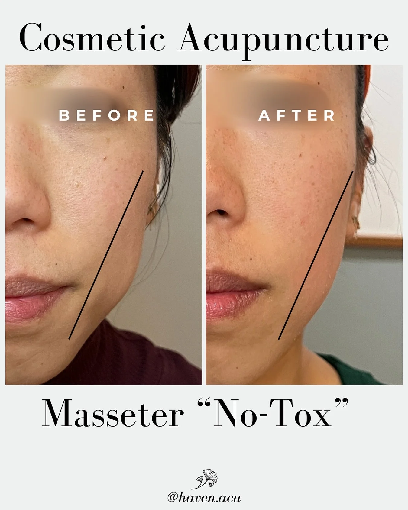 Did you know cosmetic acupuncture can slim and soften the jawline - without Botox?

Tight masseter muscles (the ones we clench when stressed) can make the face look wide and tense. Botox works by freezing the overactive muscle. Cosmetic acupuncture w
