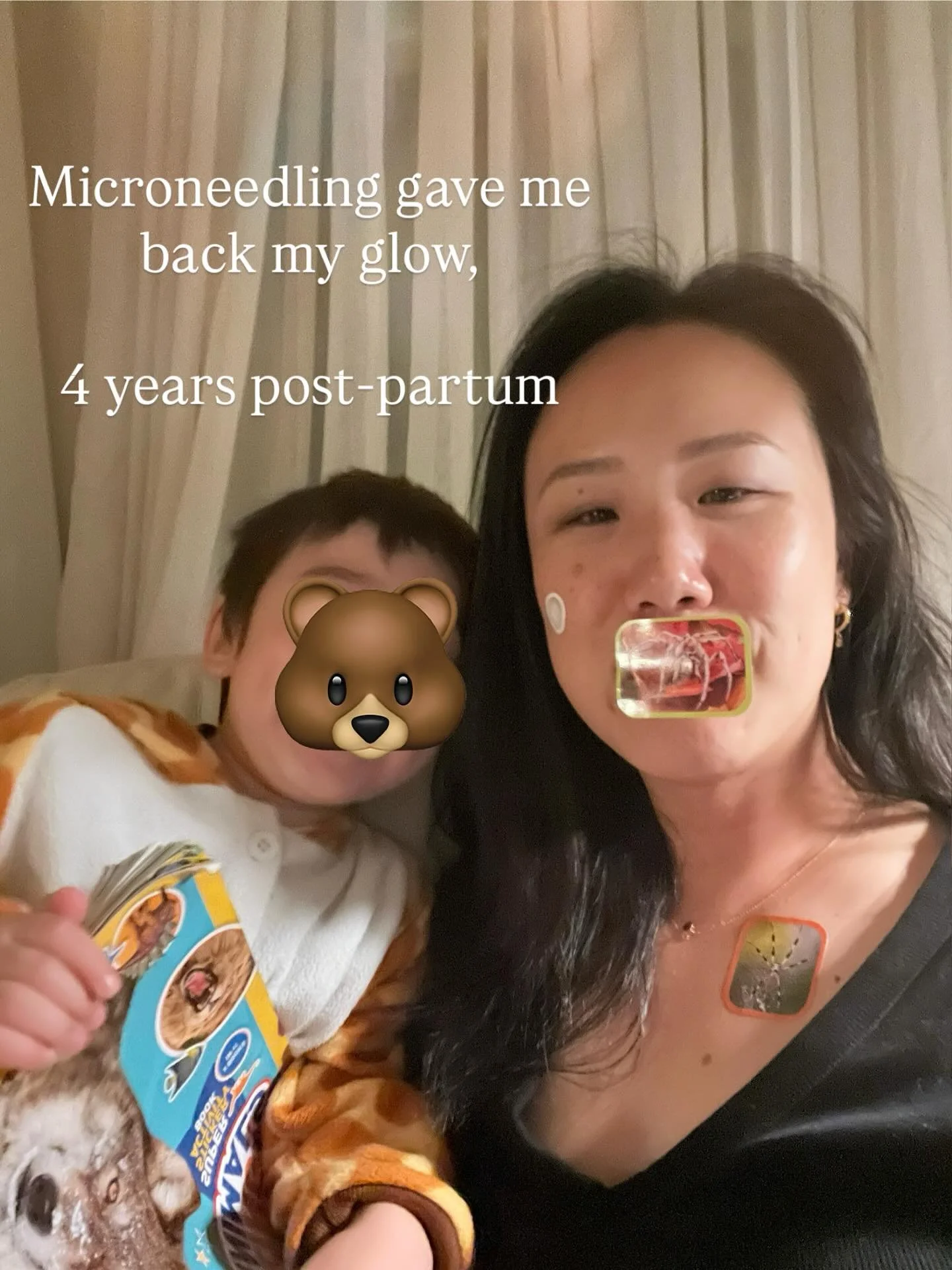 Microneedling often gets a reputation for sounding intense, but in reality, it&rsquo;s one of the gentlest, most natural ways to help your skin heal and reveal its own radiance. If you&rsquo;re navigating acne scars, uneven texture, or simply craving