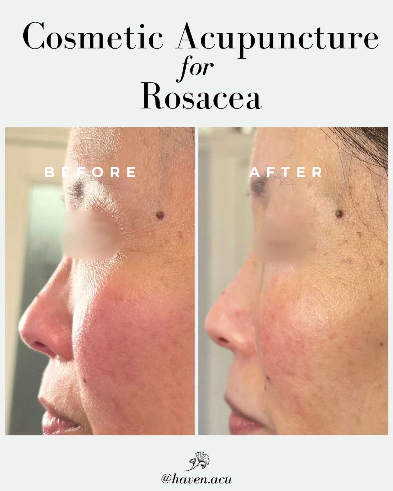 If you&rsquo;re navigating rosacea, uneven redness, or sensitive, easily-flushed skin, cosmetic acupuncture offers a calming, restorative path forward. This gentle, time-tested technique helps regulate inflammation while naturally boosting collagen a
