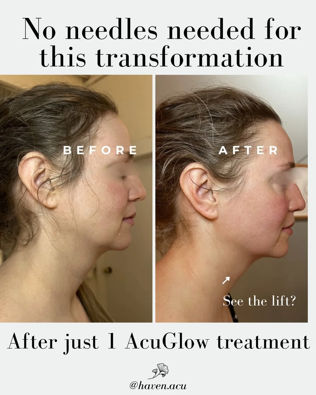 Maybe you&rsquo;re curious about facial acupuncture, but not quite ready for needles. I get it.

Introducing AcuGlow - a completely needle-FREE treatment using ancient facial cupping &amp; gua sha techniques that have been around for thousands of yea