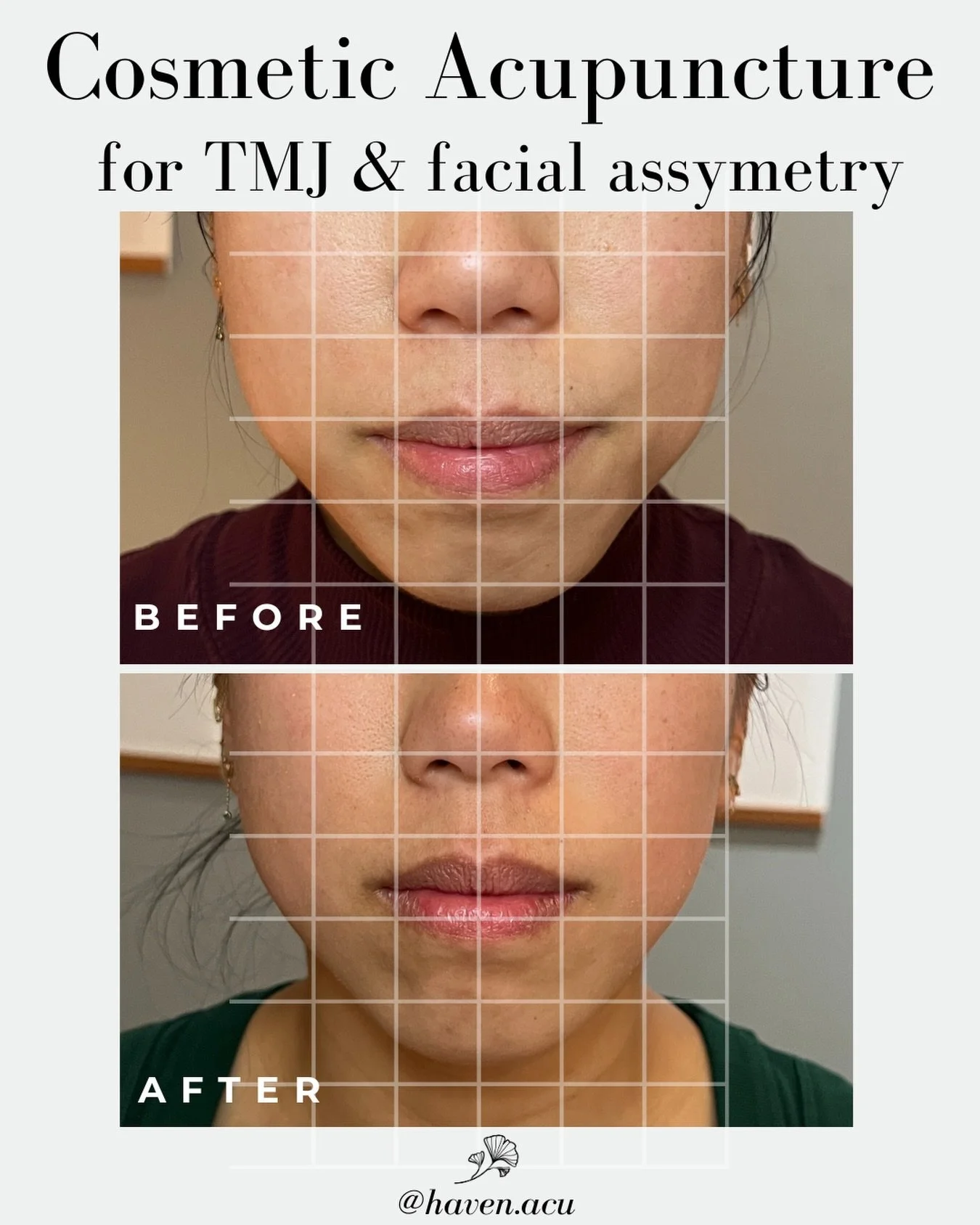 Your jaw is working overtime - even when you don&rsquo;t realize it.

Maybe you wake up with a sore, tight jaw. Maybe you catch yourself clenching throughout the day. Or maybe the tension has built up so much that you&rsquo;re dealing with TMJ pain, 