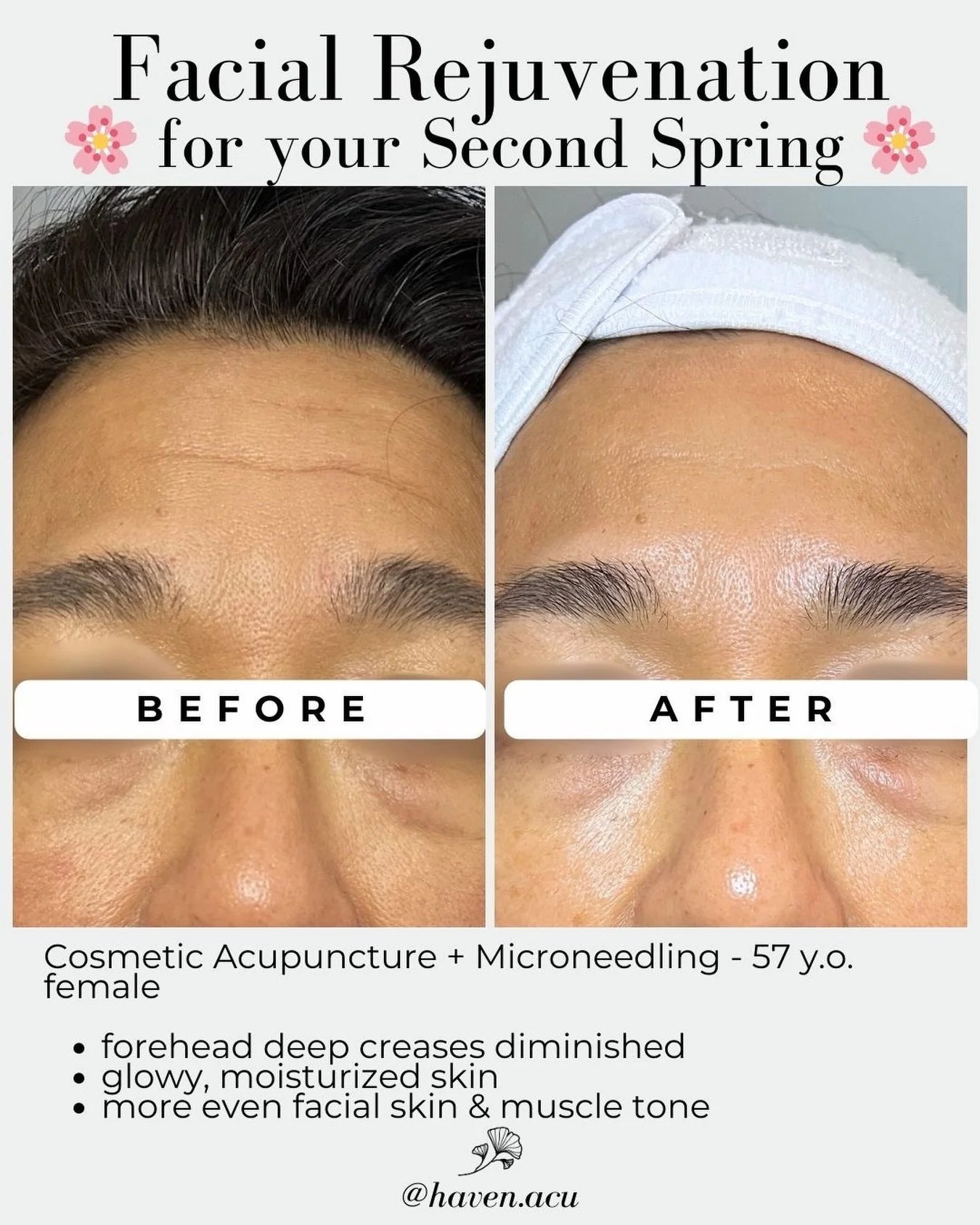 Most people think cosmetic acupuncture is just a natural alternative to Botox or fillers.

And yes - it absolutely reduces fine lines, tightens skin, and creates a genuine glow. But if you&rsquo;re in perimenopause or menopause (what Chinese Medicine