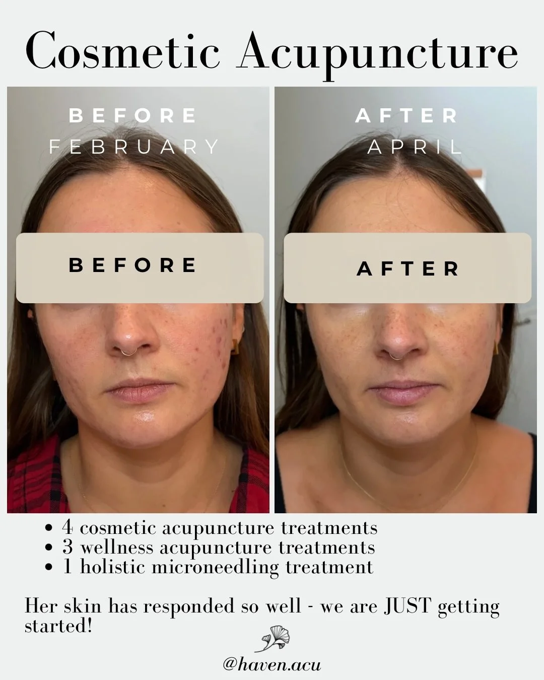 This beautiful bride-to-be is prepping her skin for a fall wedding and I&rsquo;m so proud of her commitment to healing and her RESULTS. 

We are only just getting started! She&rsquo;s 1/3 way through a treatment series of cosmetic acupuncture and hol