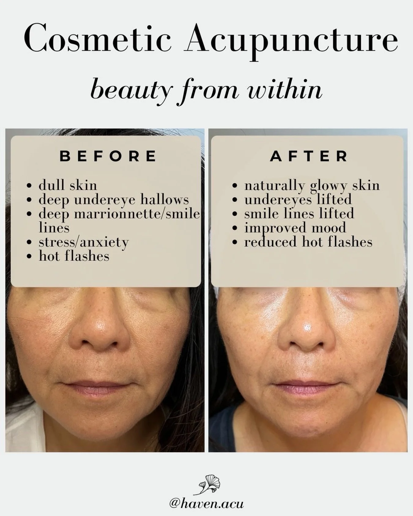 This is what happens when your face gets to rest, recover, and be seen.

Cosmetic acupuncture works with your body&rsquo;s own healing intelligence - building collagen, lifting tissue and facial muscles, while calming the nervous system. 

No fillers