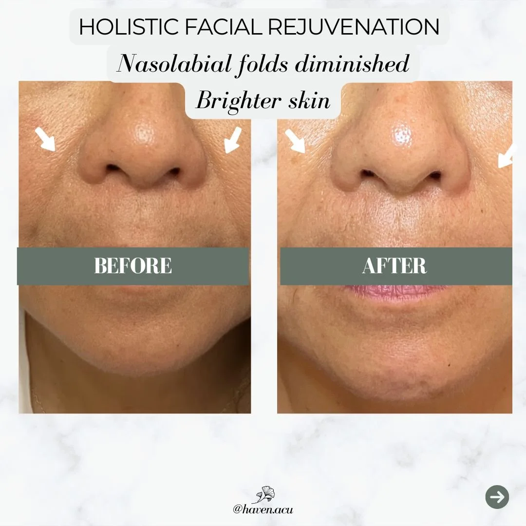 Before and after comparison of a person's nose showing facial rejuvenation results, with decreased nasolabial folds and brighter skin following a treatment.