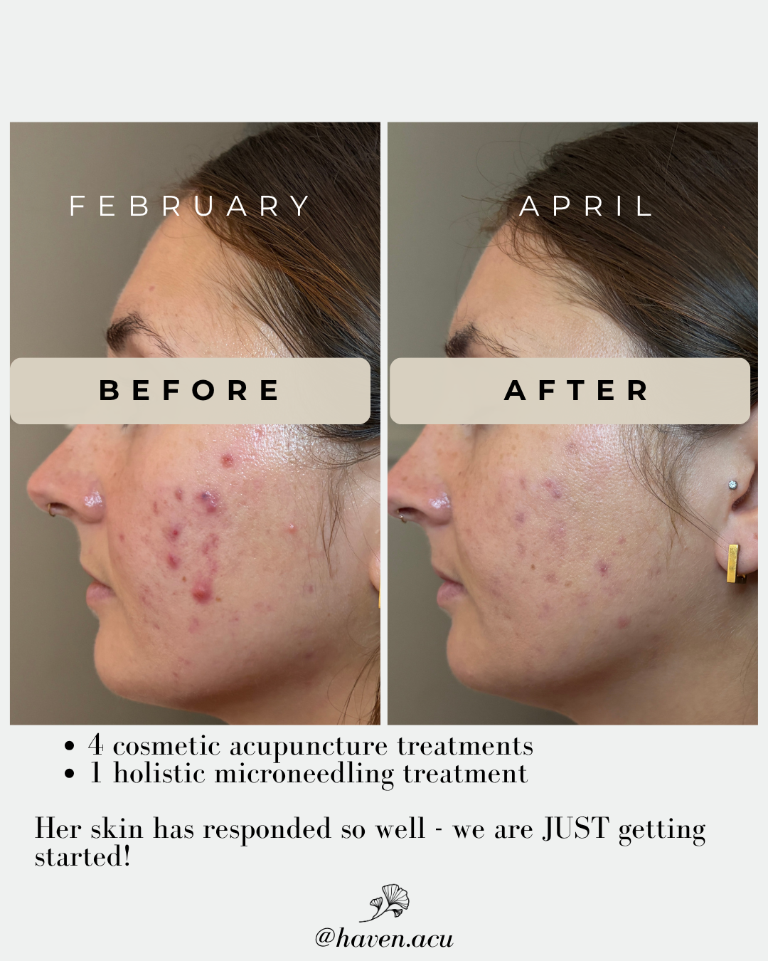 Before/After of treatment of acne scars. The "after" photo shows reduced redness and scars overall with partial treatment. With continued treatment, results will continue.